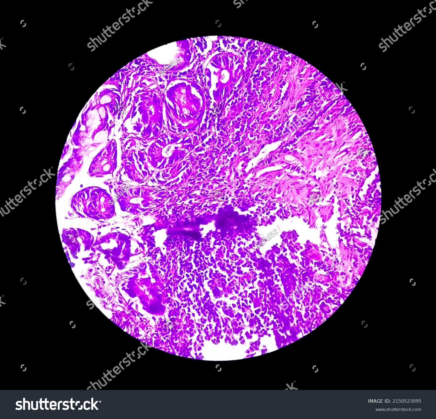 is-chronic-ileitis-a-curable-one