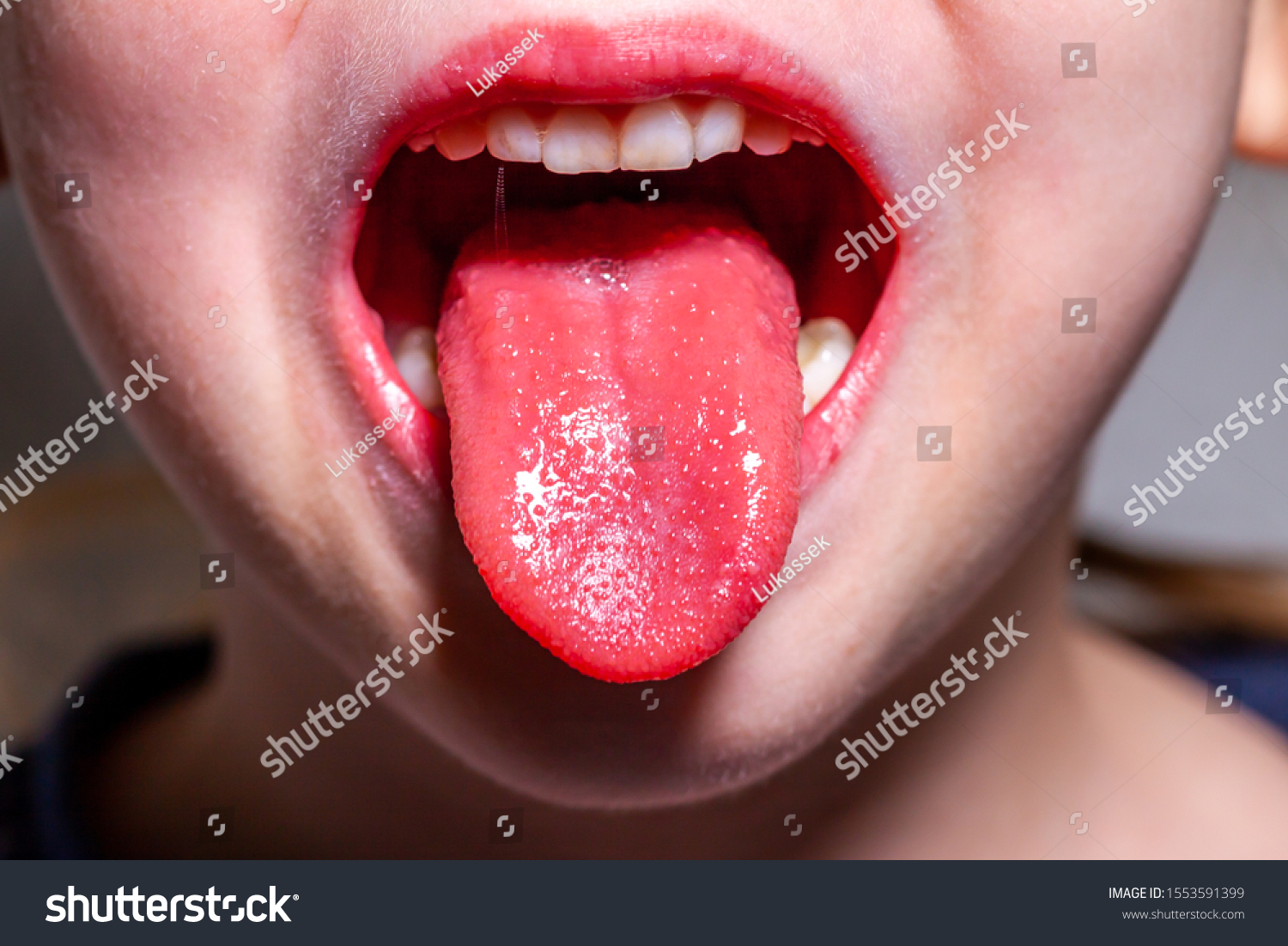 tongue-child-scarlet-fever-strawberry-tongue