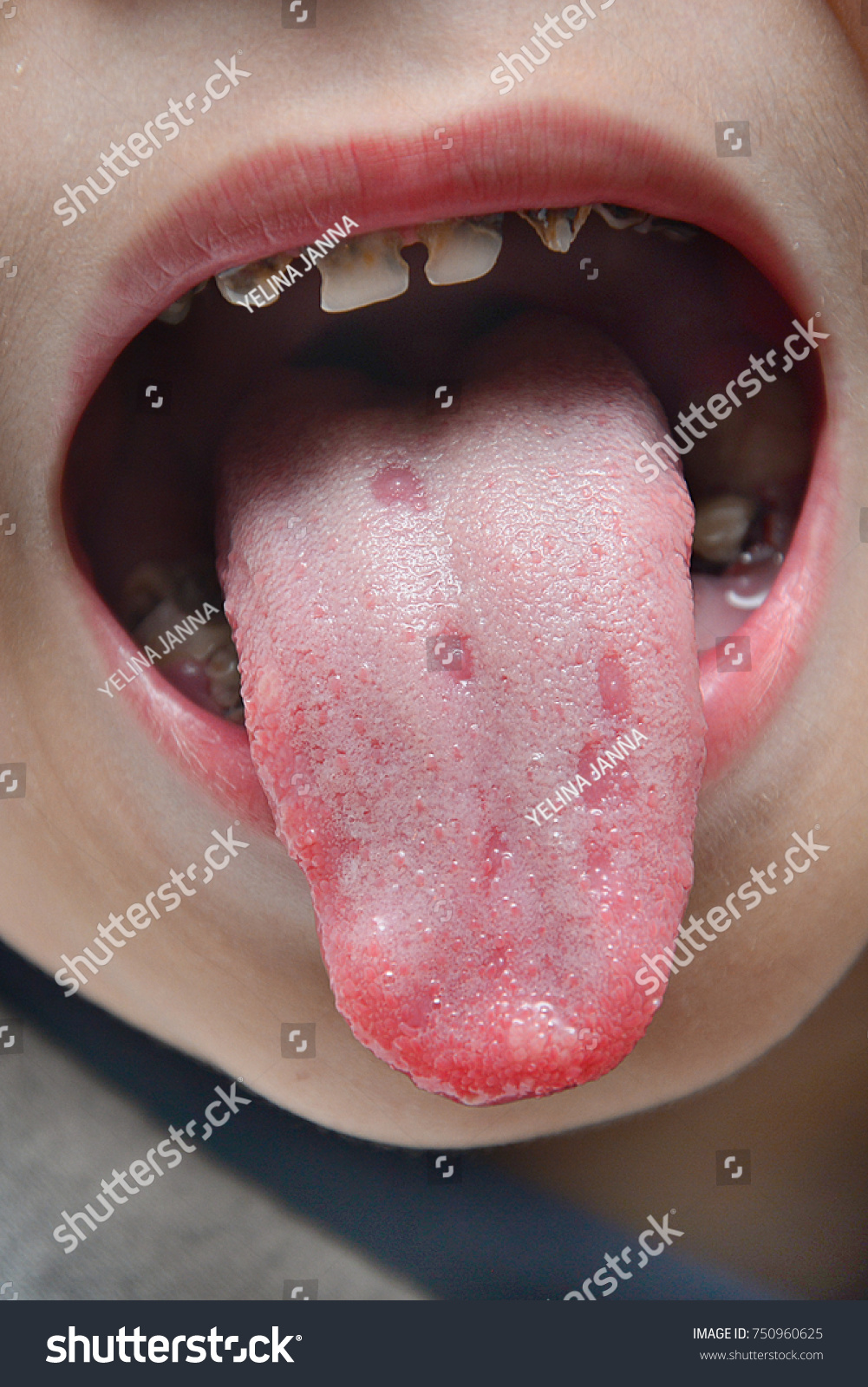 An ulcer in the tongue in children: causes and methods of treatment 61 An ulcer in the tongue in children: causes and methods of treatment 1