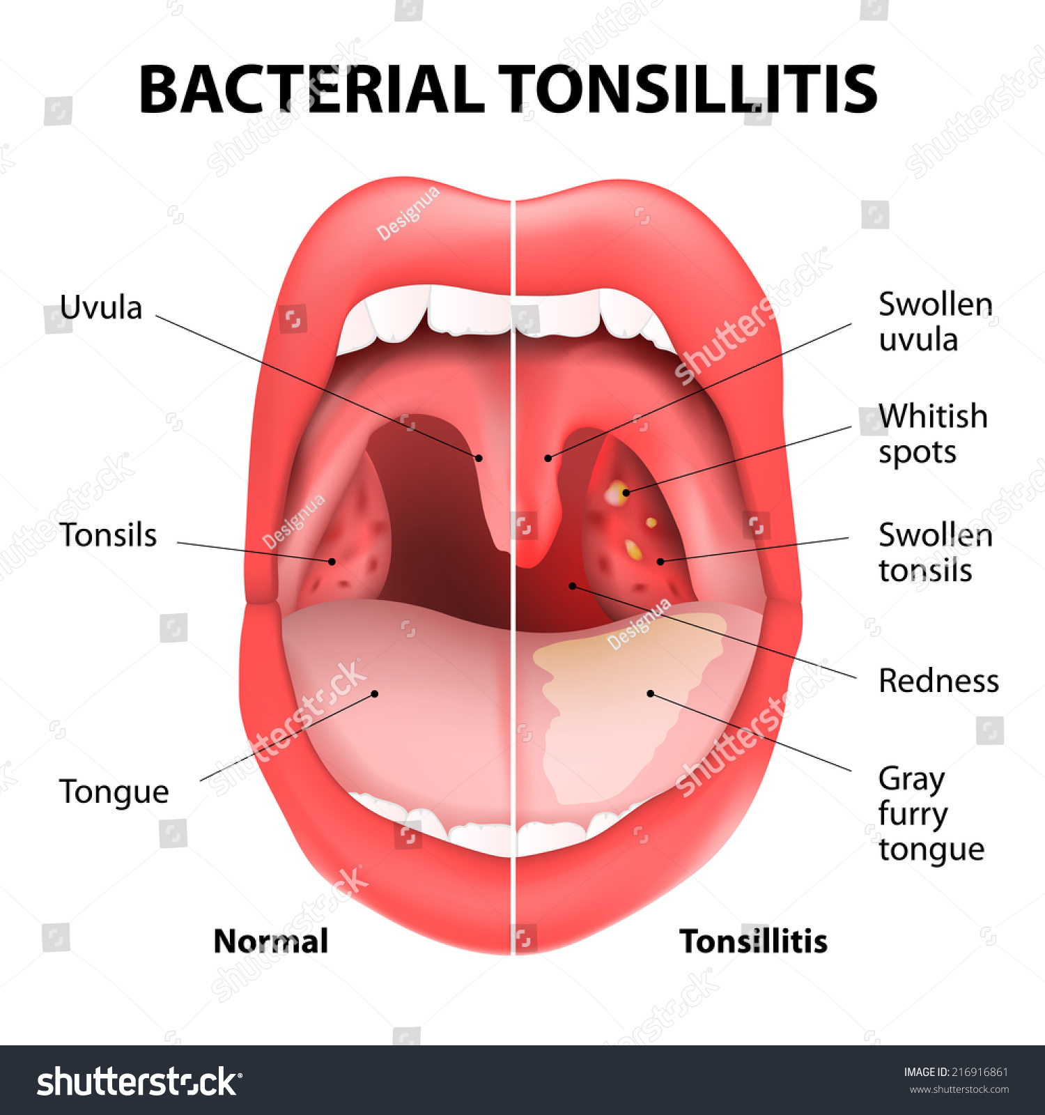 Tonsillitis Bacterial Stock Illustration 216916861 - Shutterstock