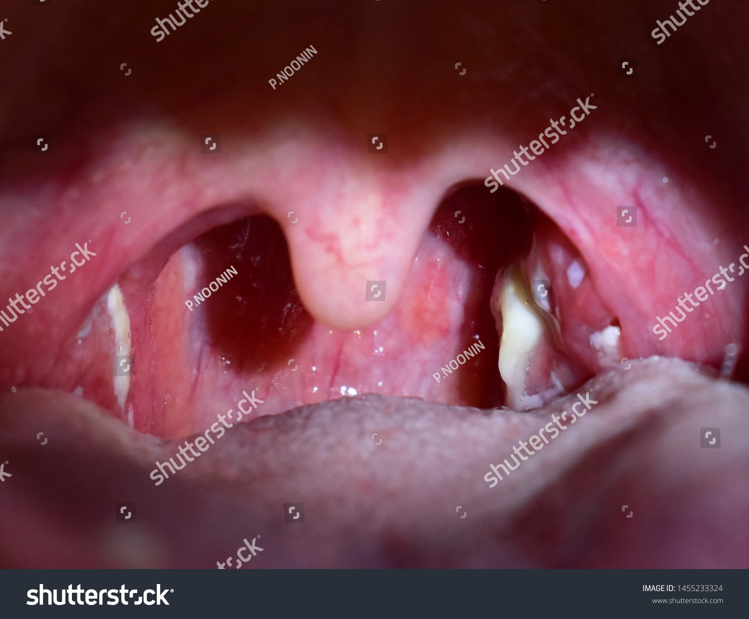 Tonsillitis Pus On Tonsils Throat Infection Foto De Stock 1455233324