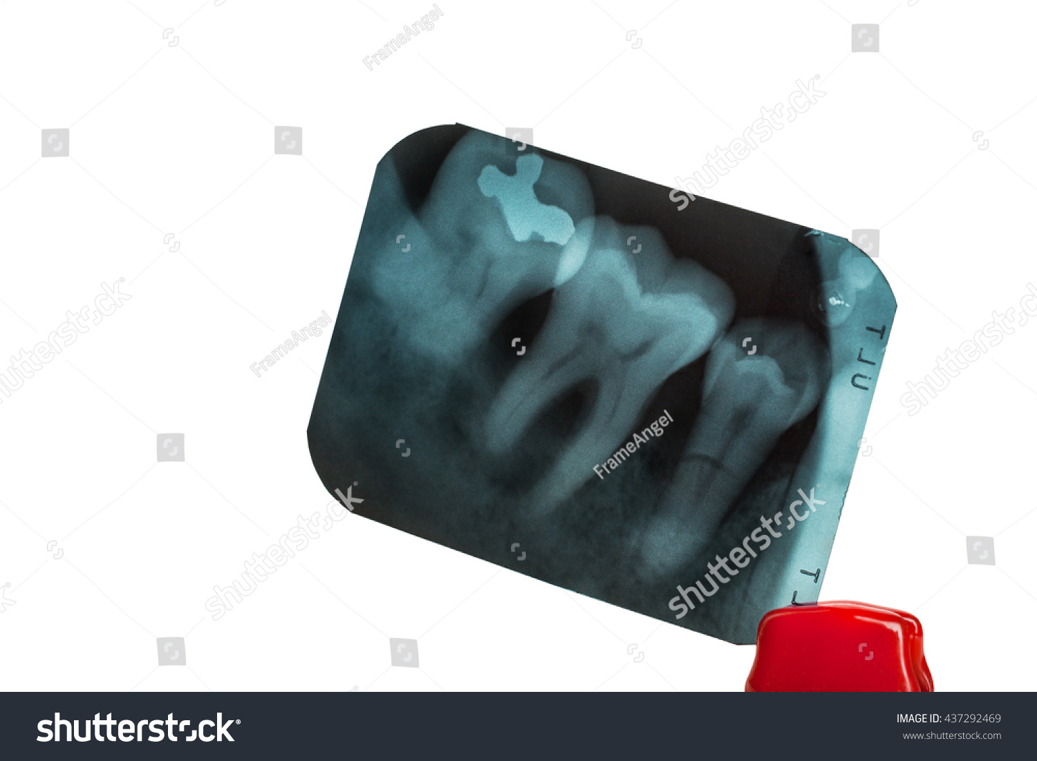 Tooth Overlapping Teeth Xray Film Showing Stock Photo (Edit Now) 437292469