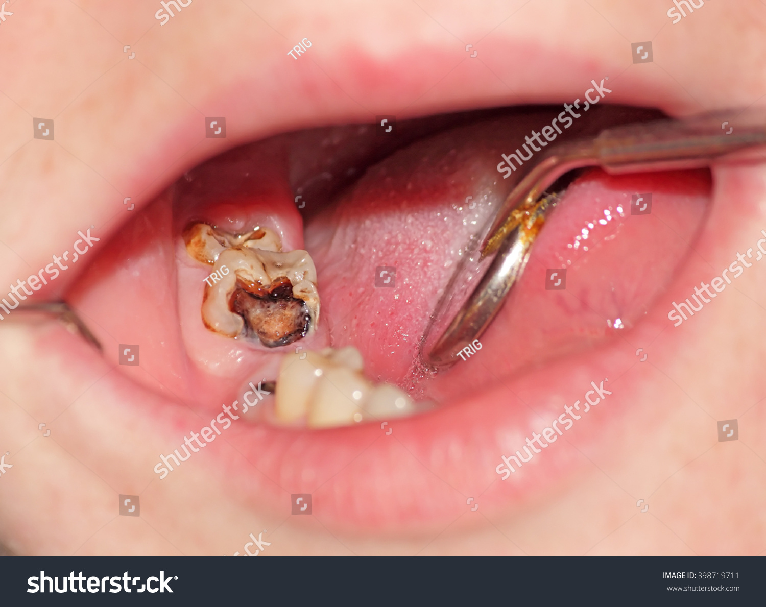 Molar Tooth Cavity