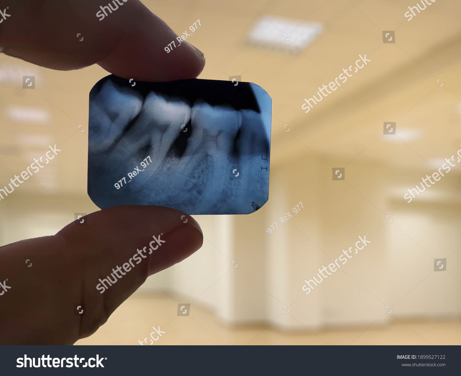 Tooth Xray Hand Opposite Light Periodontal Stock Photo 1899527122 ...