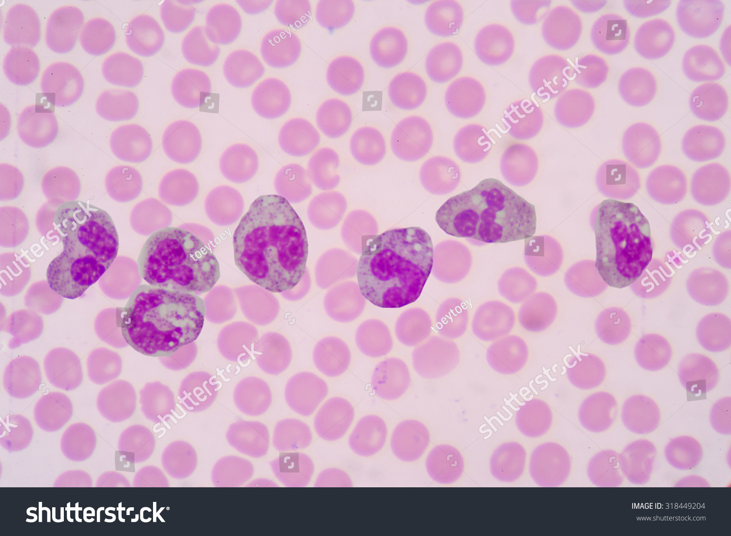 Toxic Granulation Refers To Changes In Granulocyte Cells Seen On ...