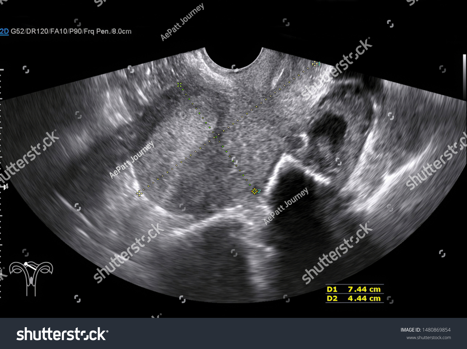 Transvaginal Semicircular Transverse Ultrasound Image Of My Xxx Hot Girl
