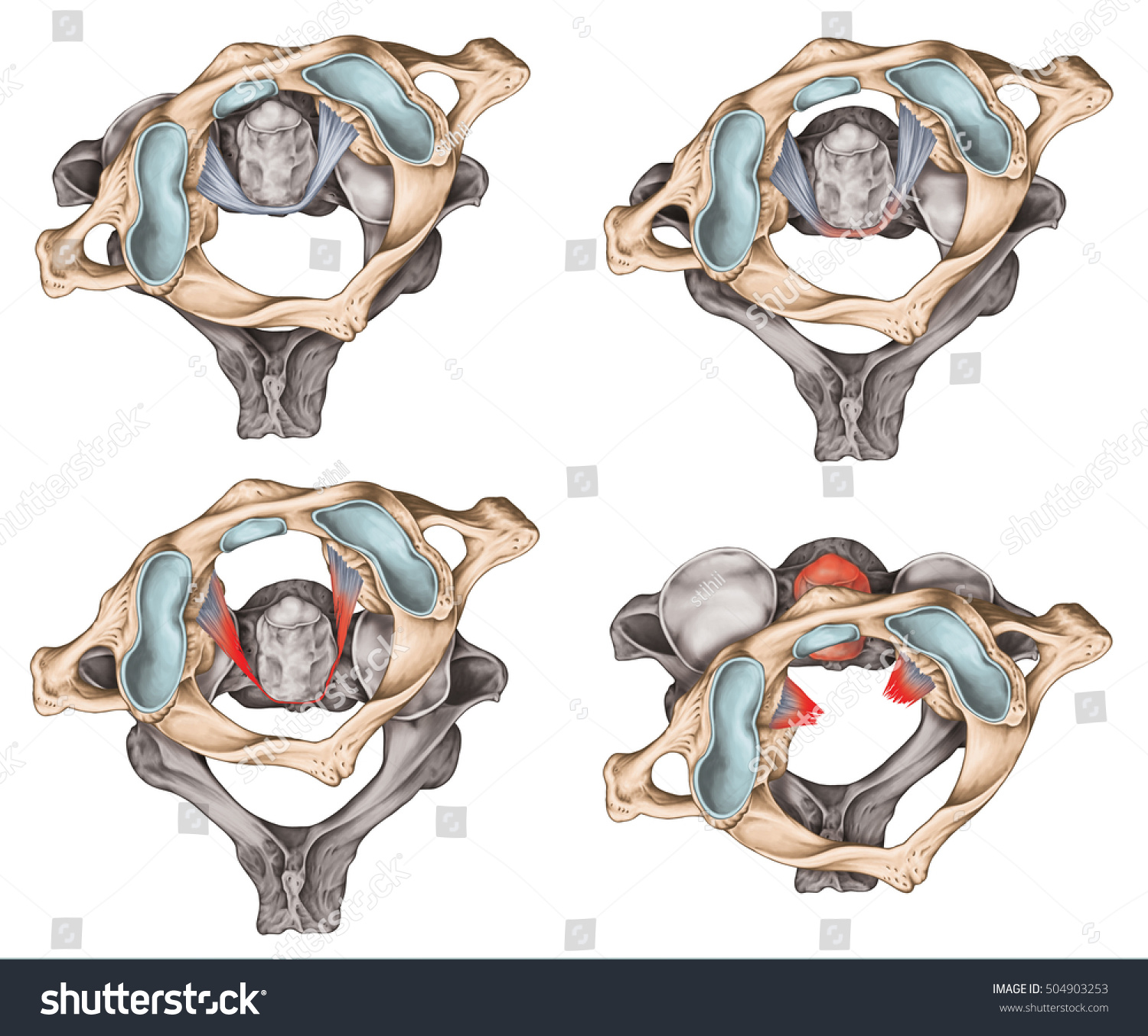 Atlantoaxial Rotary Subluxation