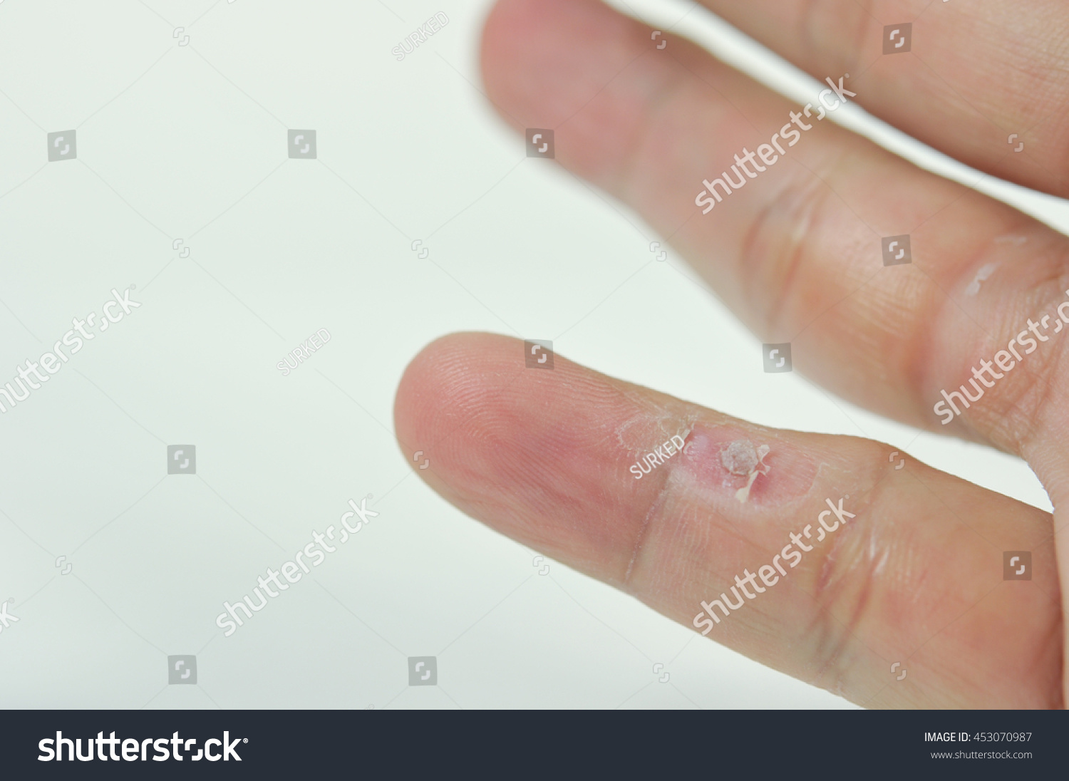 Treatment Wart On Finger By Salicylic Acid. Stock Photo 453070987 ...