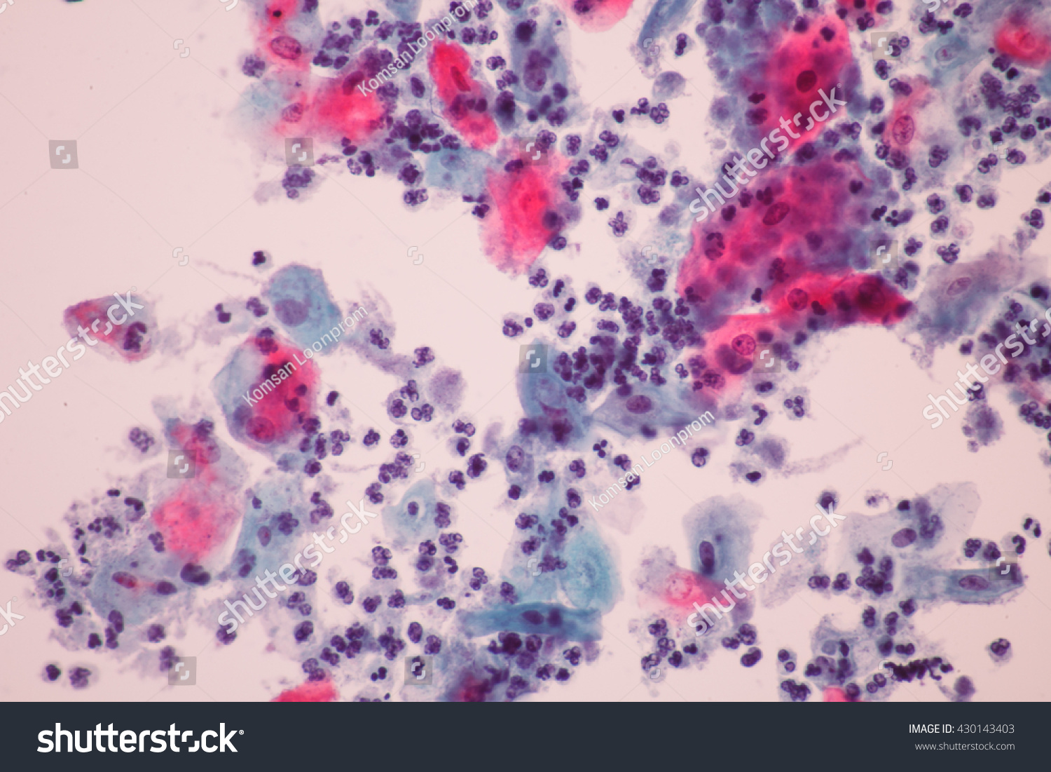 Trichomonas Pap Smear Cytology View Microscopicmedical Stock Photo ...