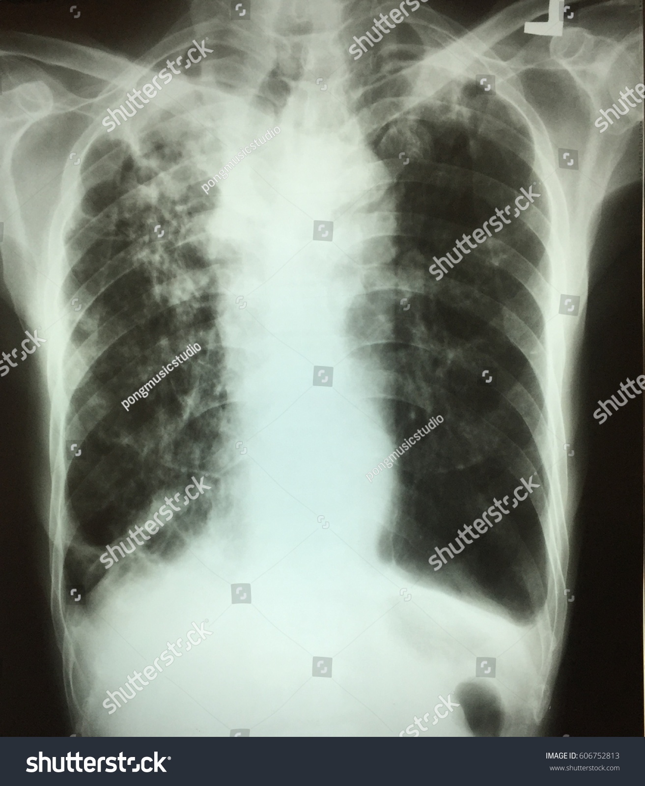 Tuberculosis Chest Xray Film Demonstrated On Stock Photo 606752813 ...