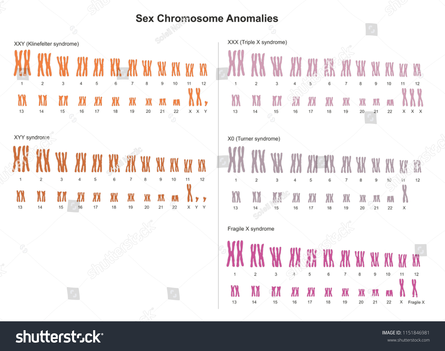 ターナー クラインフェルター 三重のx症候群 三重のy症候群は 性染色体の余剰または欠落によって引き起こされる遺伝的条件である のイラスト素材 1151846981