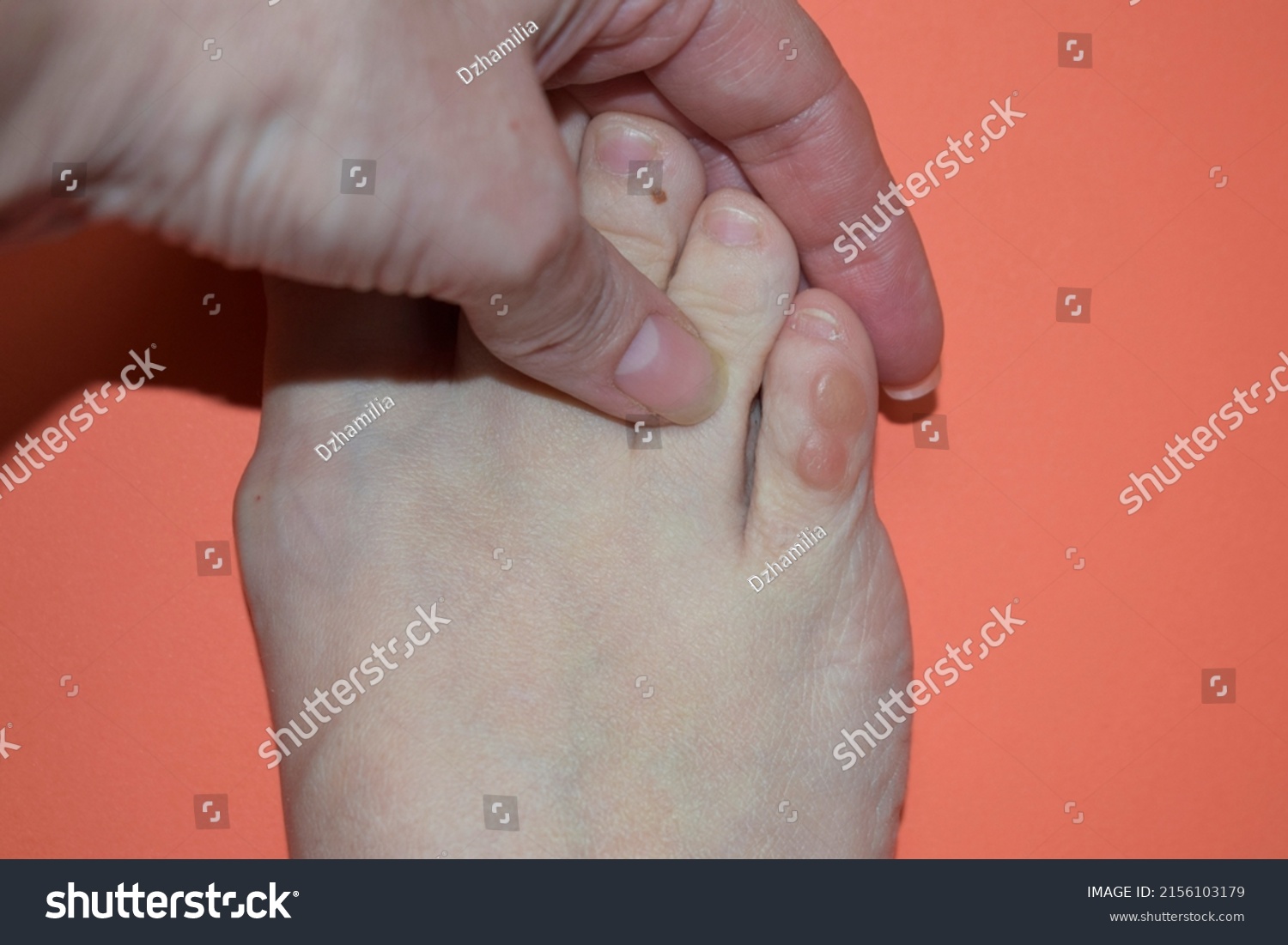 two-calluses-on-little-toe-womans-stock-photo-2156103179-shutterstock