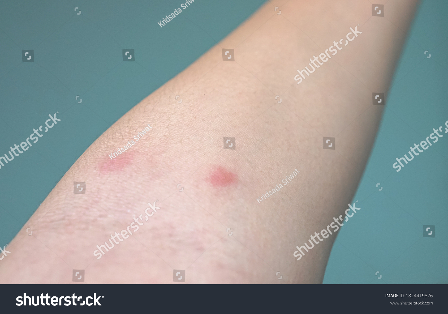 two-red-rash-on-arm-skin-stock-photo-1824419876-shutterstock