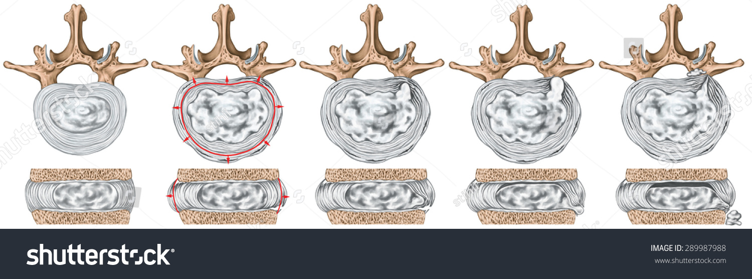 Types And Stages Of Lumbar Disc Herniation, Herniated Disc, Nuclear ...