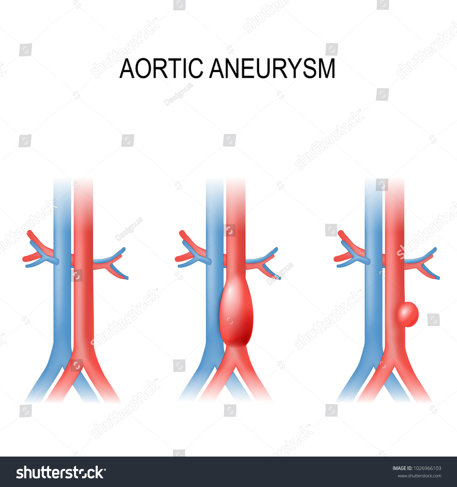 Types Abdominal Aortic Aneurysm Normal Aorta Ilustración De Stock 1026966103 9529