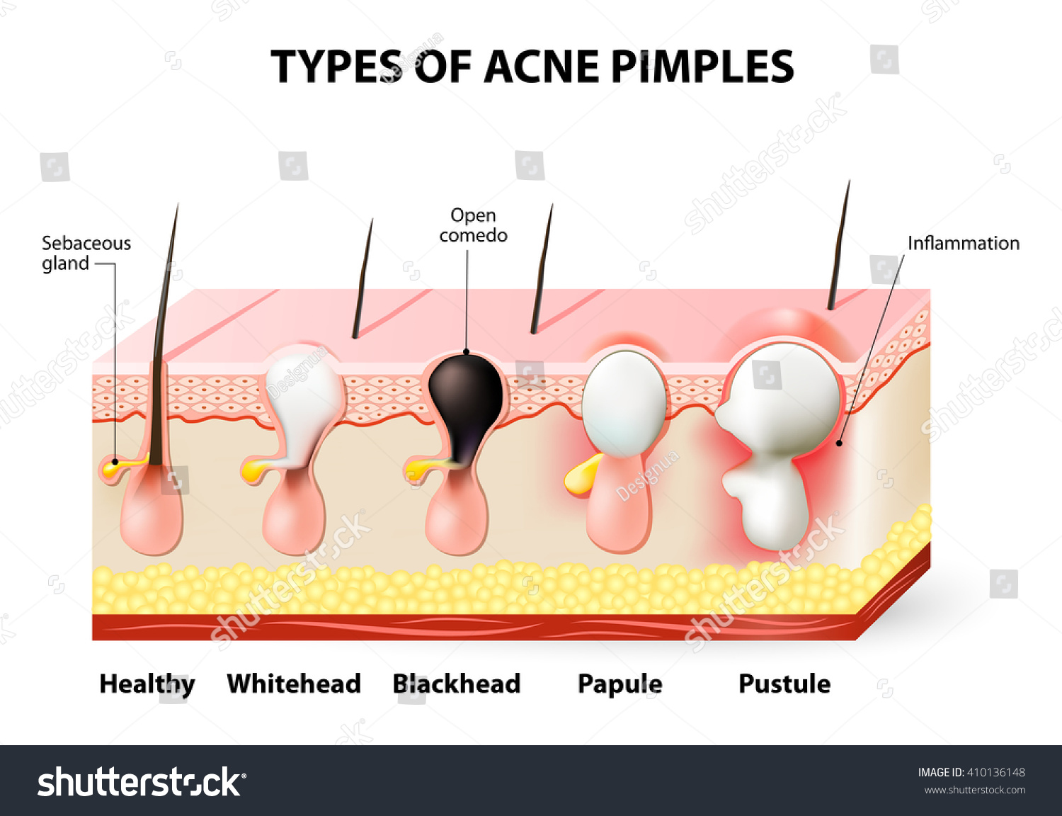 Types Acne Pimples Healthy Skin Whiteheads Stock Illustration 410136148 ...