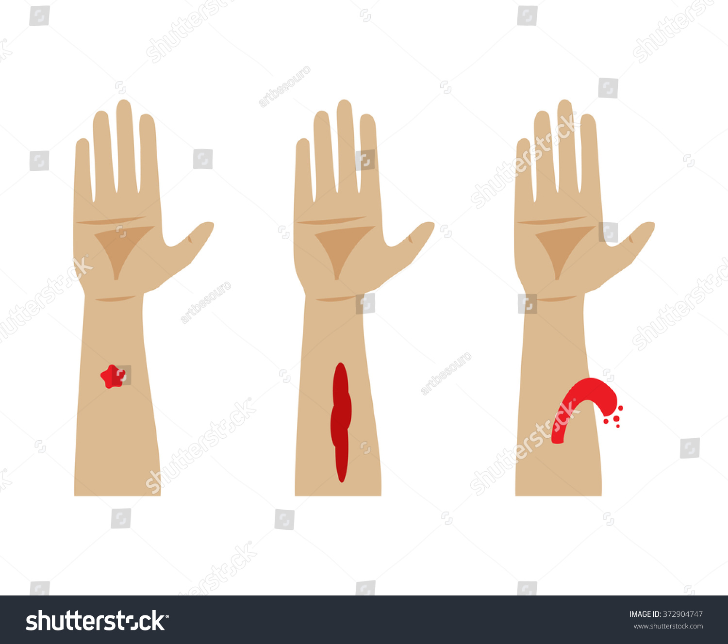 Types Of Bleeding. Capillary, Venous And Arterial Bleeding Stock Photo ...