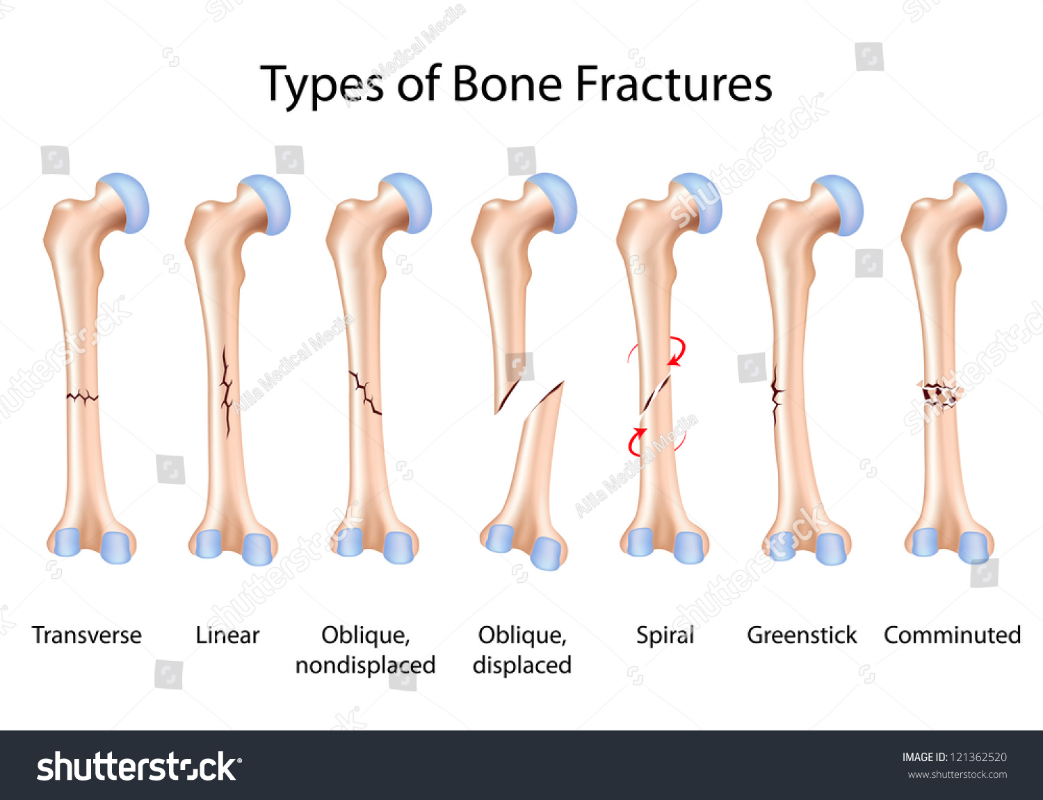 Bone Fracture Cartoon 8794