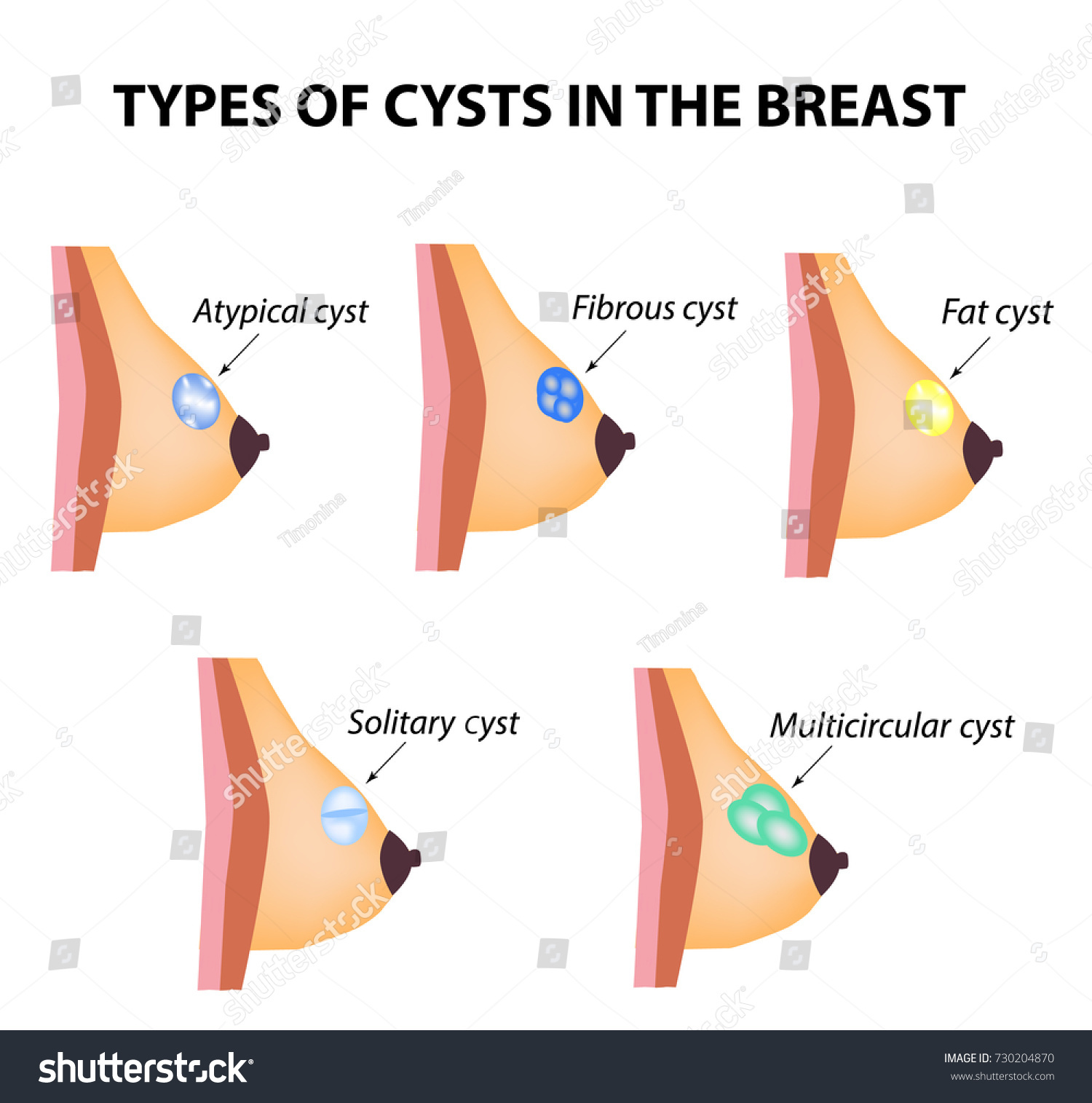 Types Cysts Breast Atypical Fibrous Fatty Stockillustration 730204870 