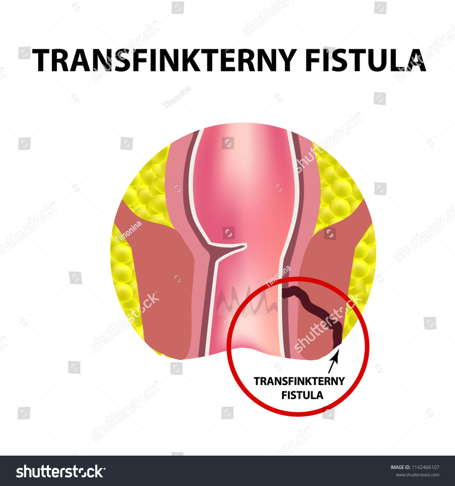 Types Fistulas Rectum Paraproctitis Anus Abscess Stock illustration types-fistulas-rectum-paraproctitis-anus-abscess-stock-illustration