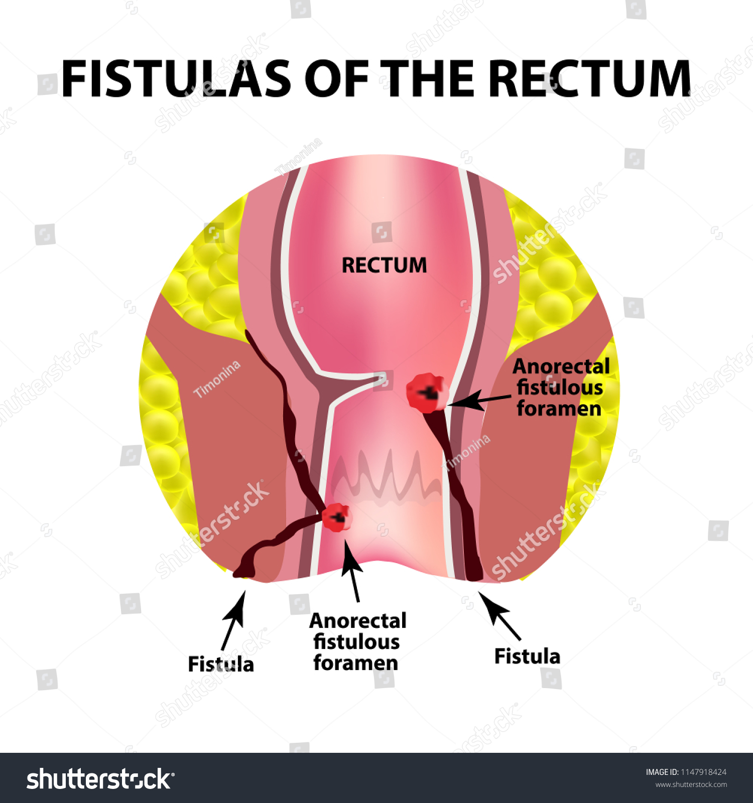 Para anal abscess photos 1