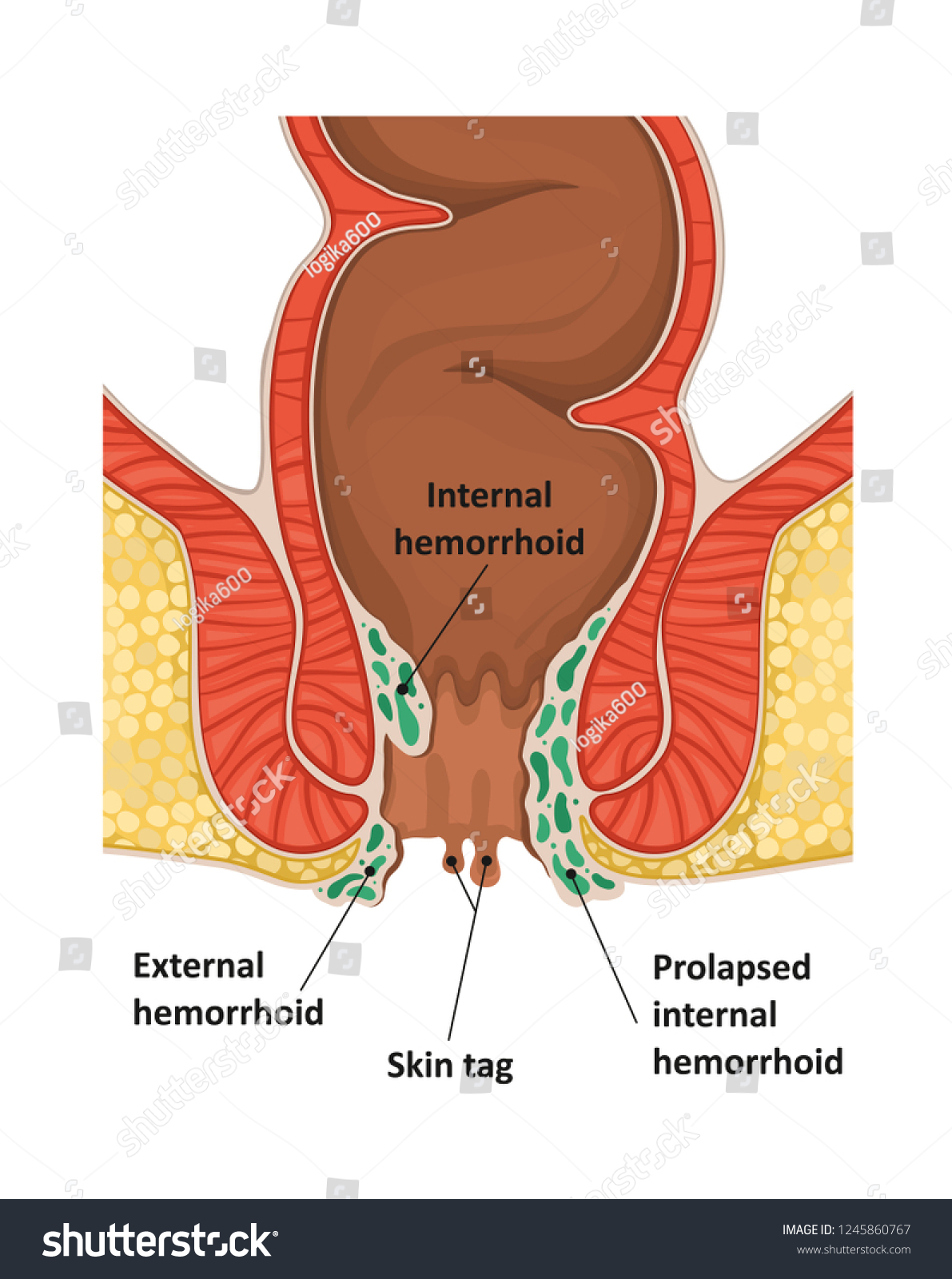 Types Hemorrhoids Internalexternal Prolapsed Internal Hemorrhoid Ilustración De Stock 2068