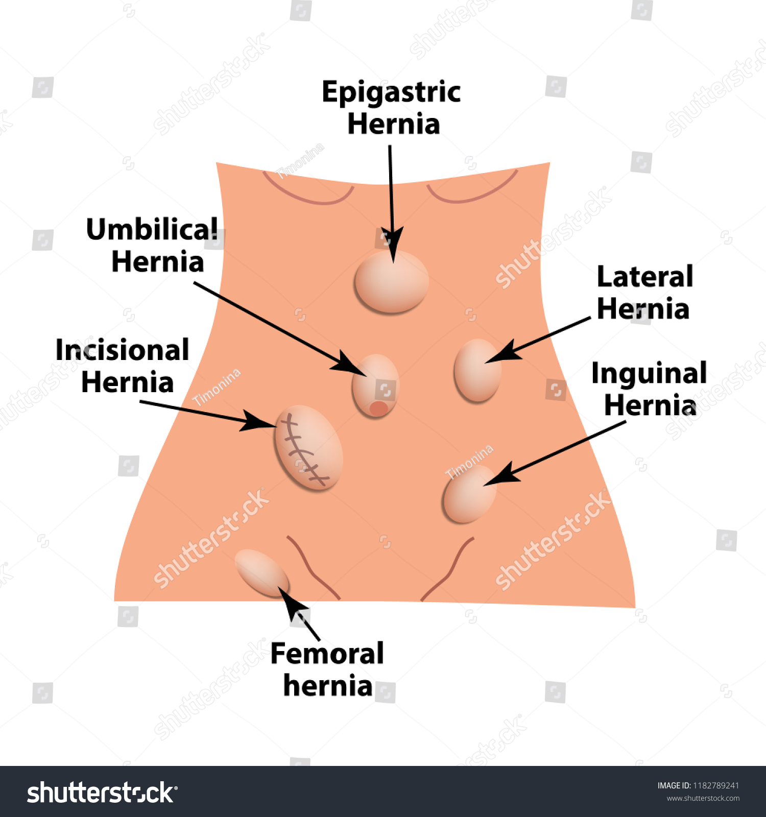 Types Hernia Lateral Umbilical Inguinal Femoral Εικονογράφηση μόδας