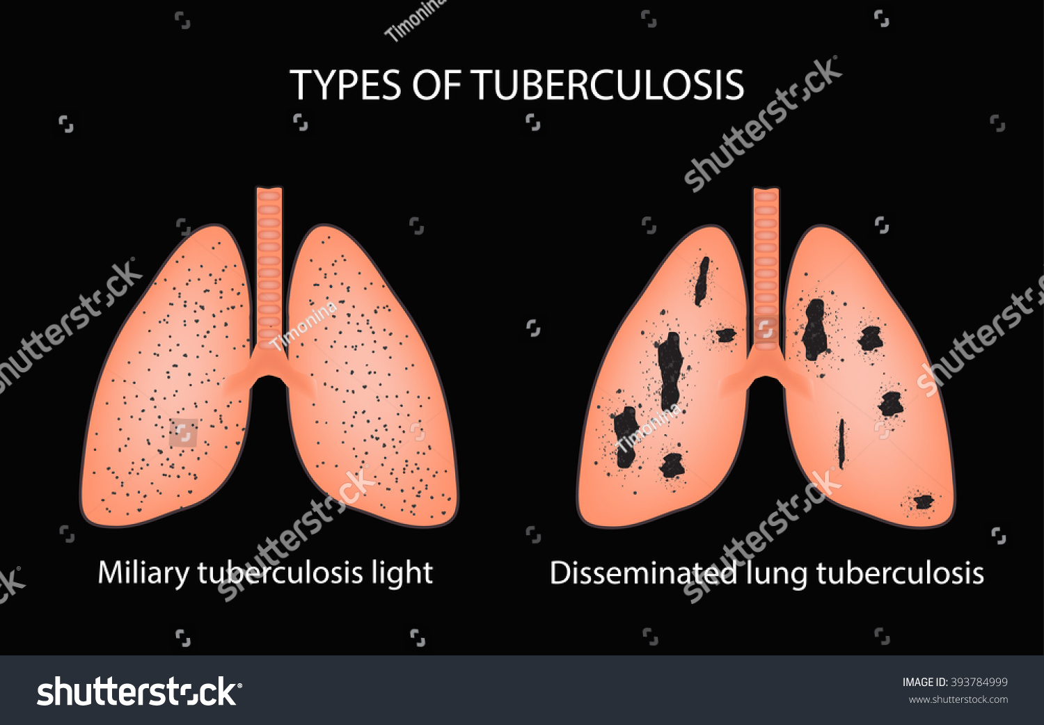 Types Tuberculosis Miliary Disseminated Pulmonary Tuberculosis Stock ...