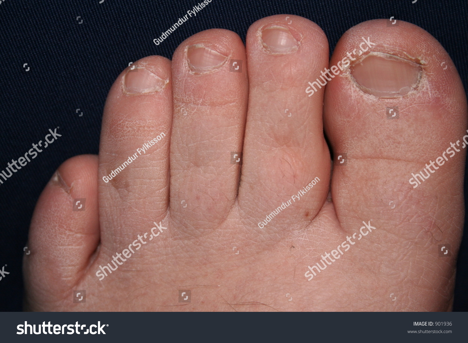Ugly Foot Stock Photo 901936 Shutterstock