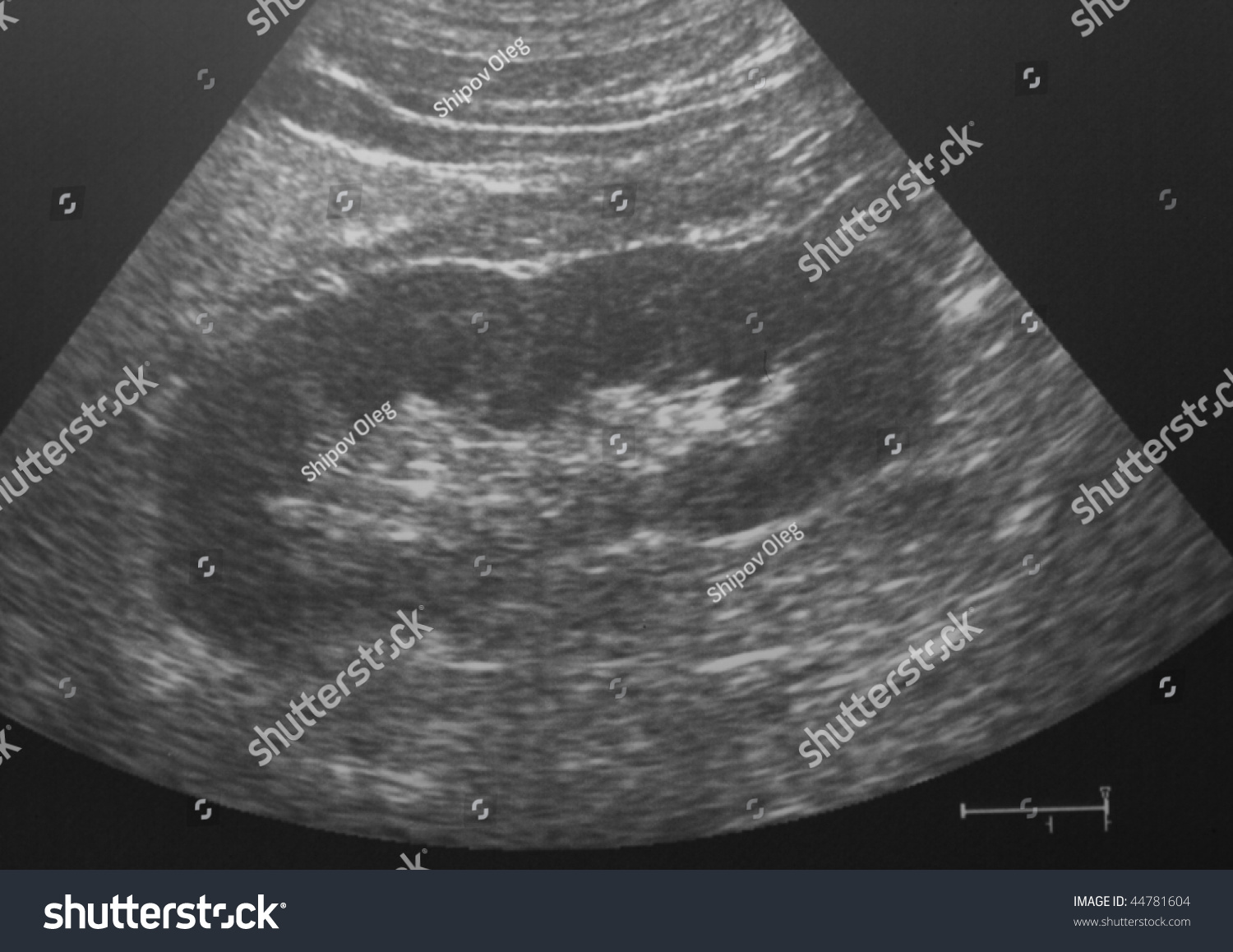 Ultrasound Image Human Normal Kidney Stock Photo 44781604 - Shutterstock