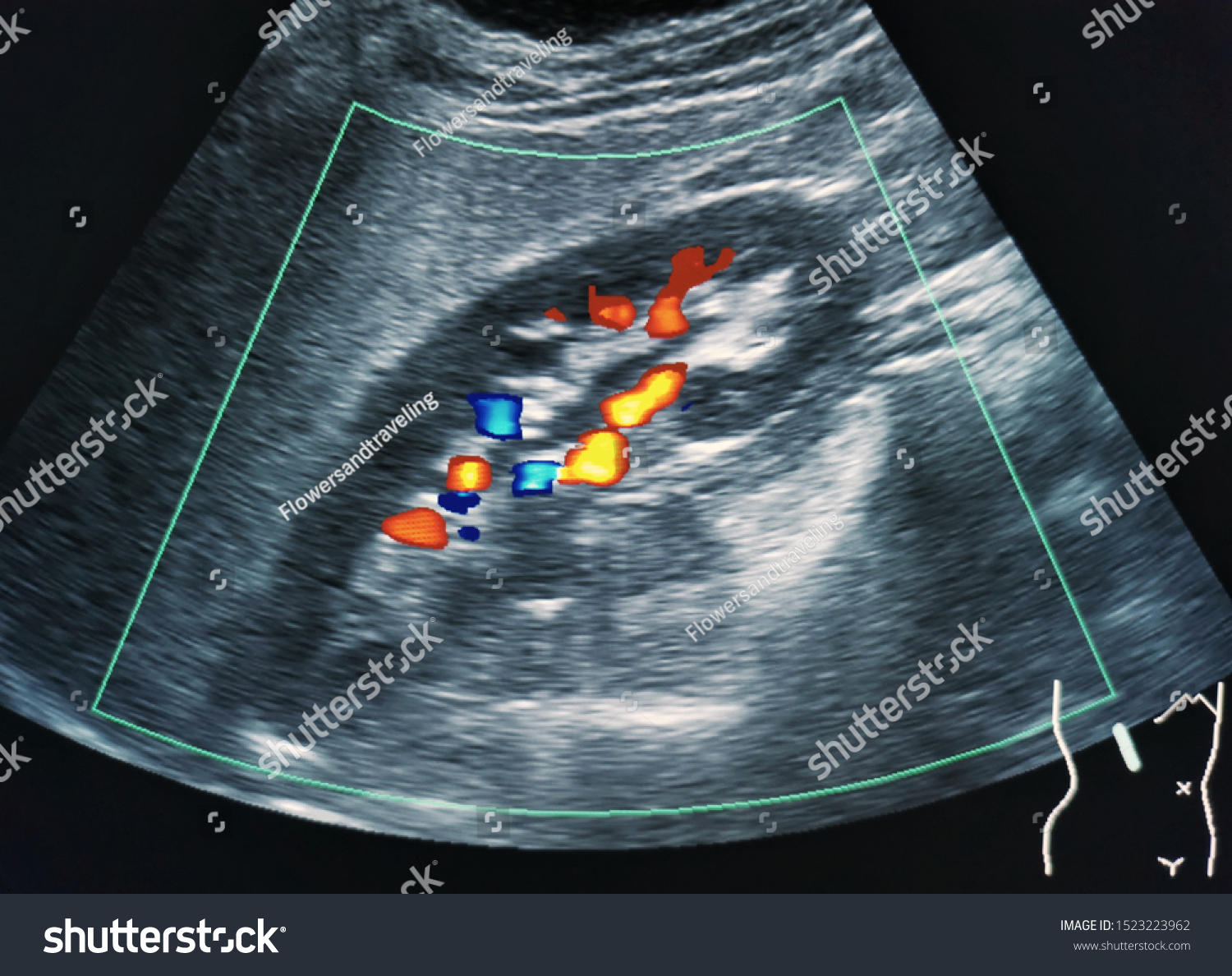 Ultrasound Image Right Kidney Colors Vascular Stock Photo (Edit Now ...