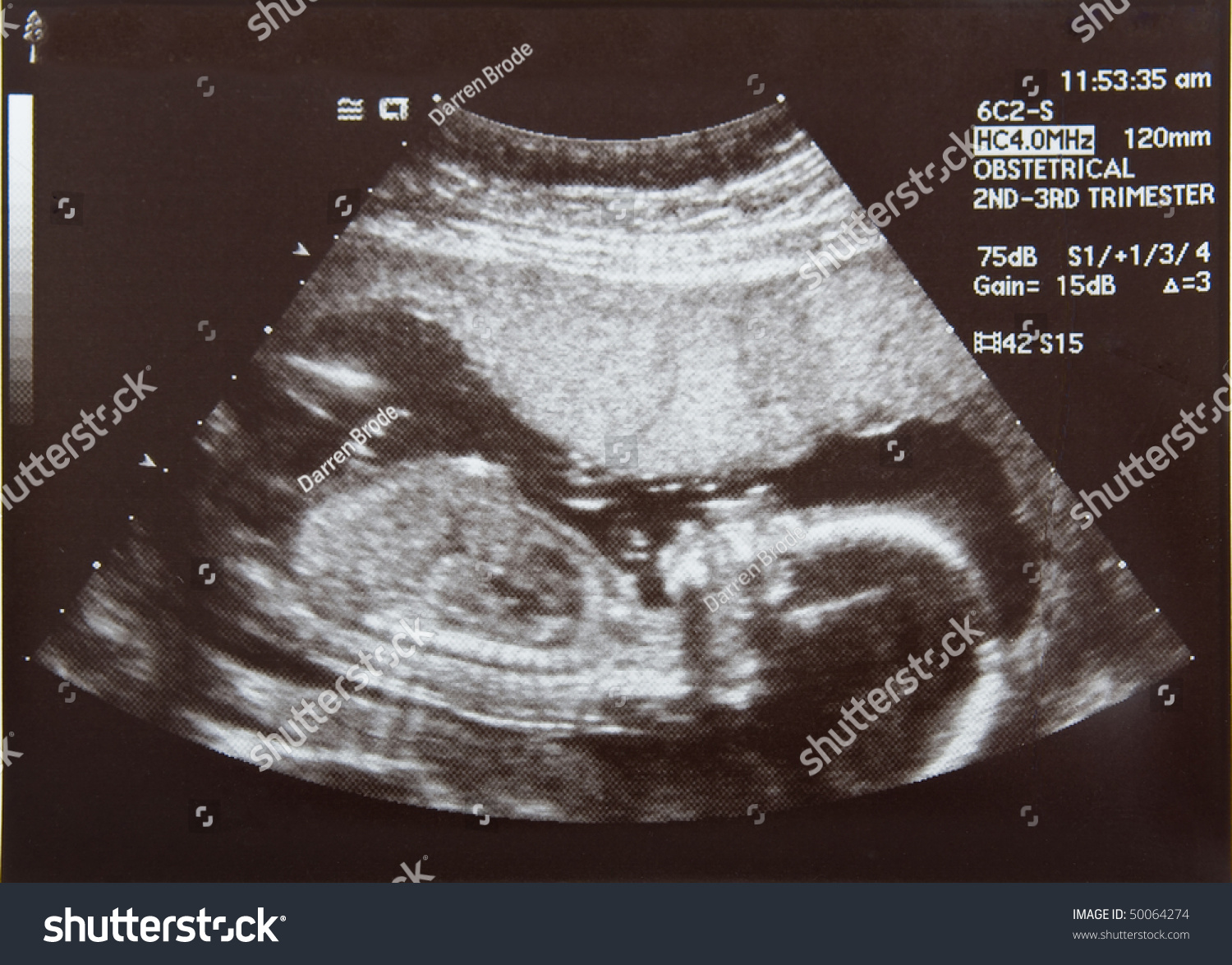 4 Months Pregnant Ultrasound