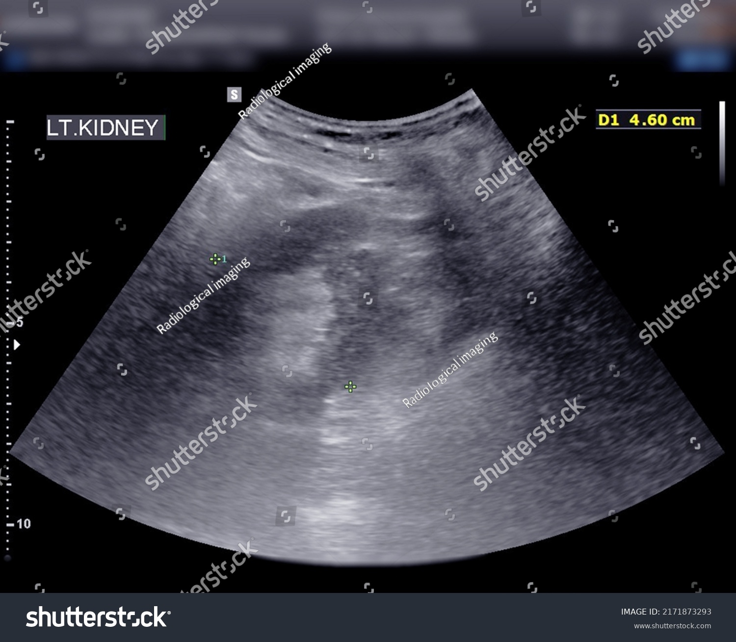 Ultrasound Urinary Bladder Kub Screening Renal Stock Illustration ...