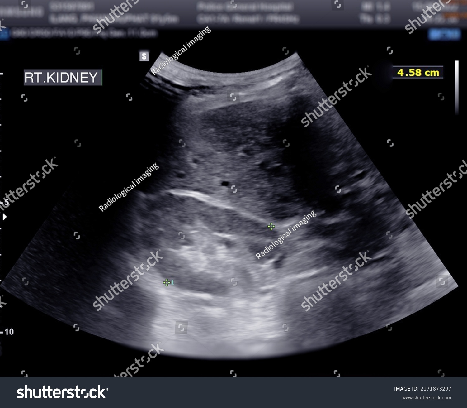 Ultrasound Urinary Bladder Kub Screening Renal Stock Illustration ...