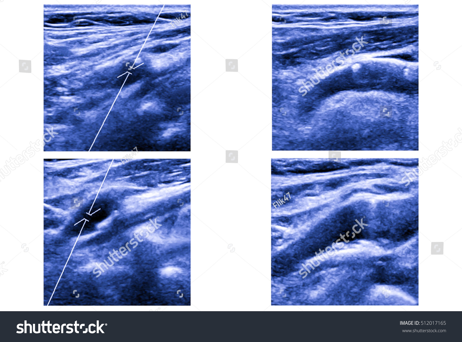 ultrasound-picture-carotid-artery-arteria-carotis-stockfoto-512017165