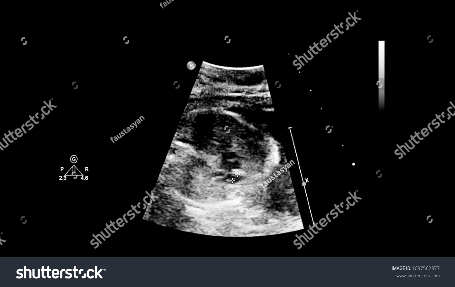 Ultrasound Screen Fetal Echocardiography Stock Photo 1697562877 ...