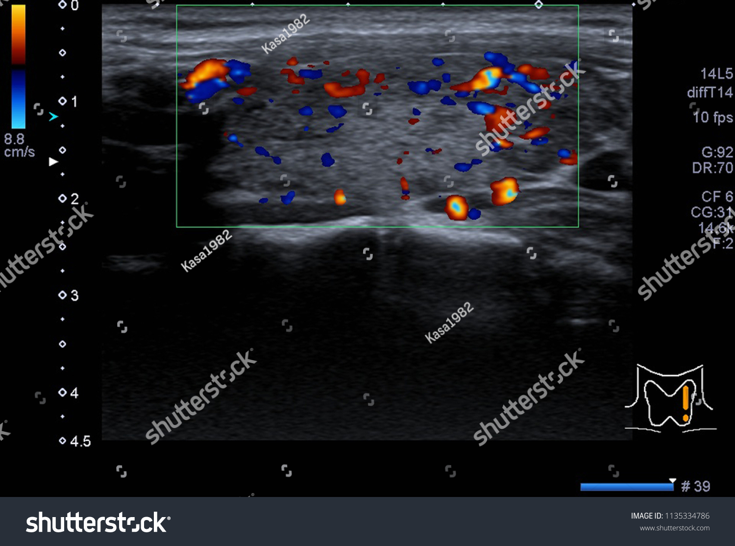 diffuse enlargement of the thyroid gland icd 10