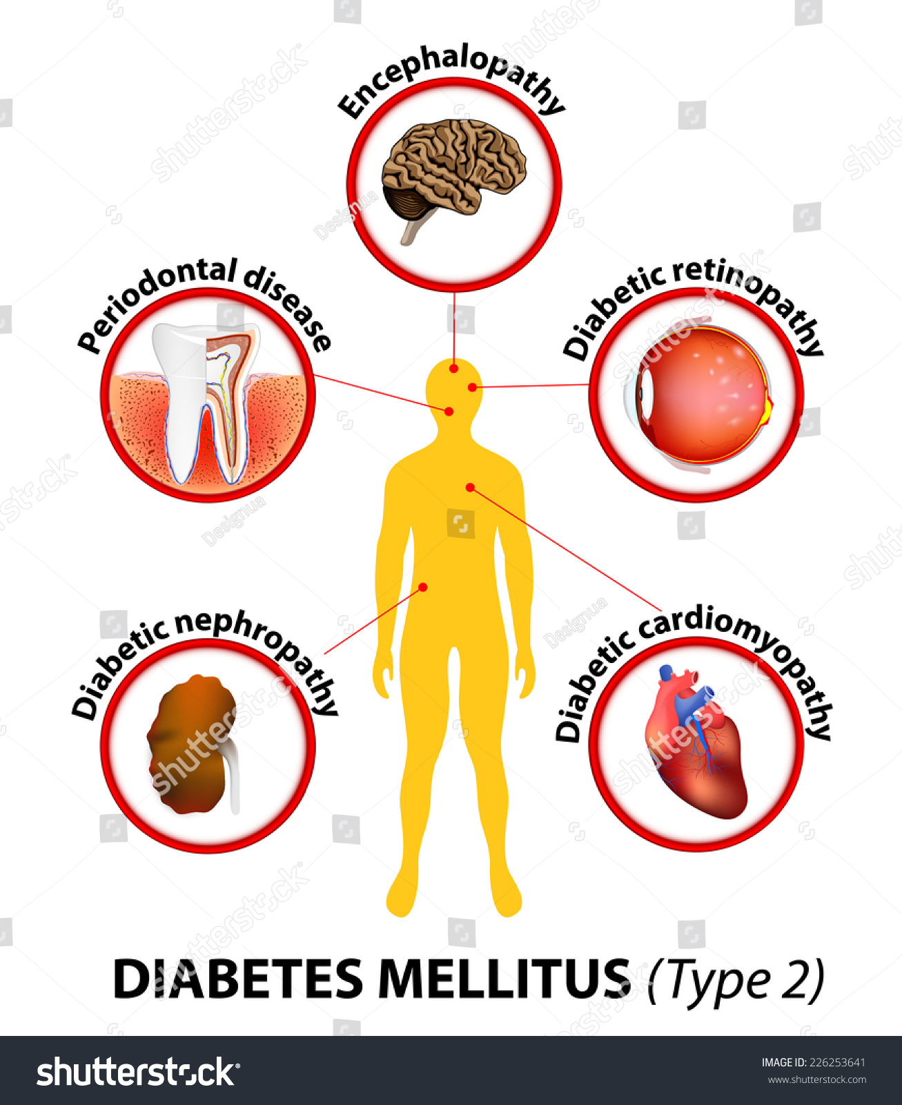 Untreated Diabetes Can Cause Many Complications Stock Illustration ...