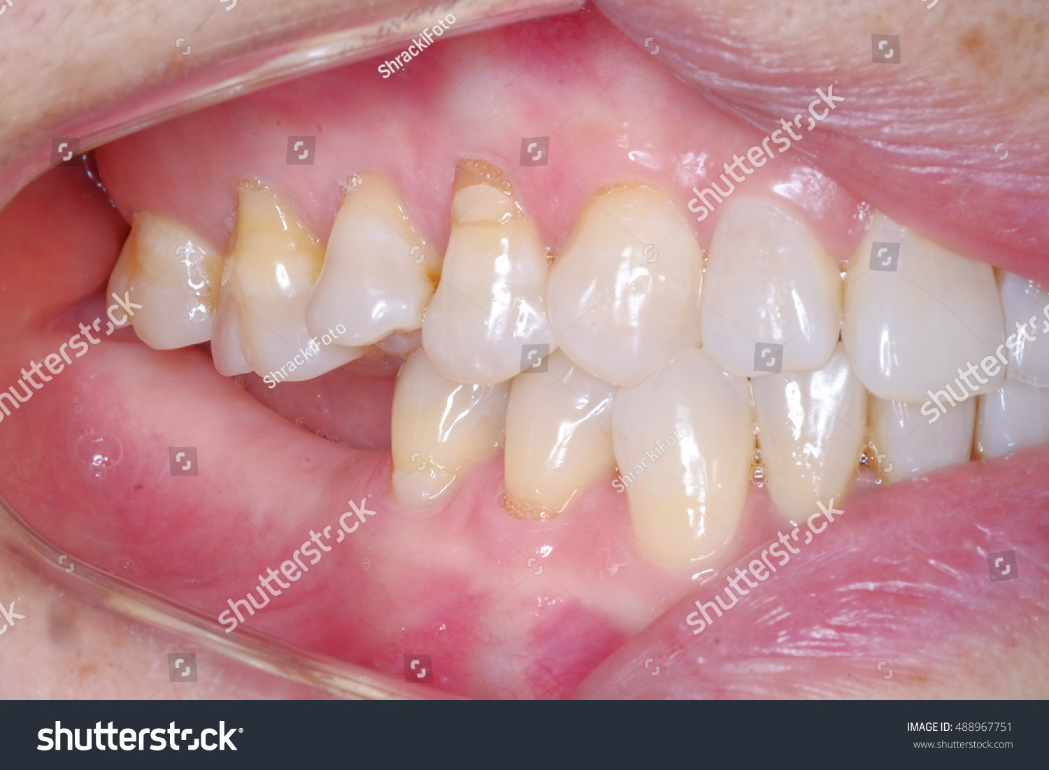 Upper Molar Teeth Over Eruption Downward Stock Photo 488967751 