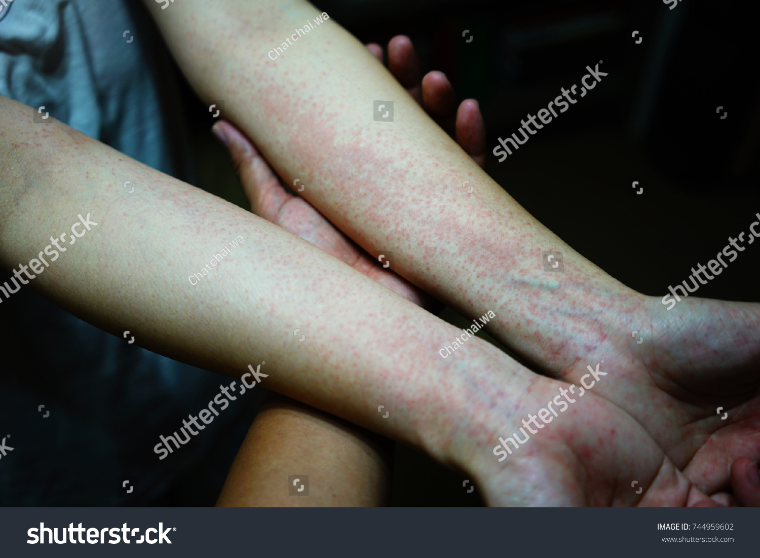 Urticaria Hives On Forearms Itchy Bumps Education Stock Image