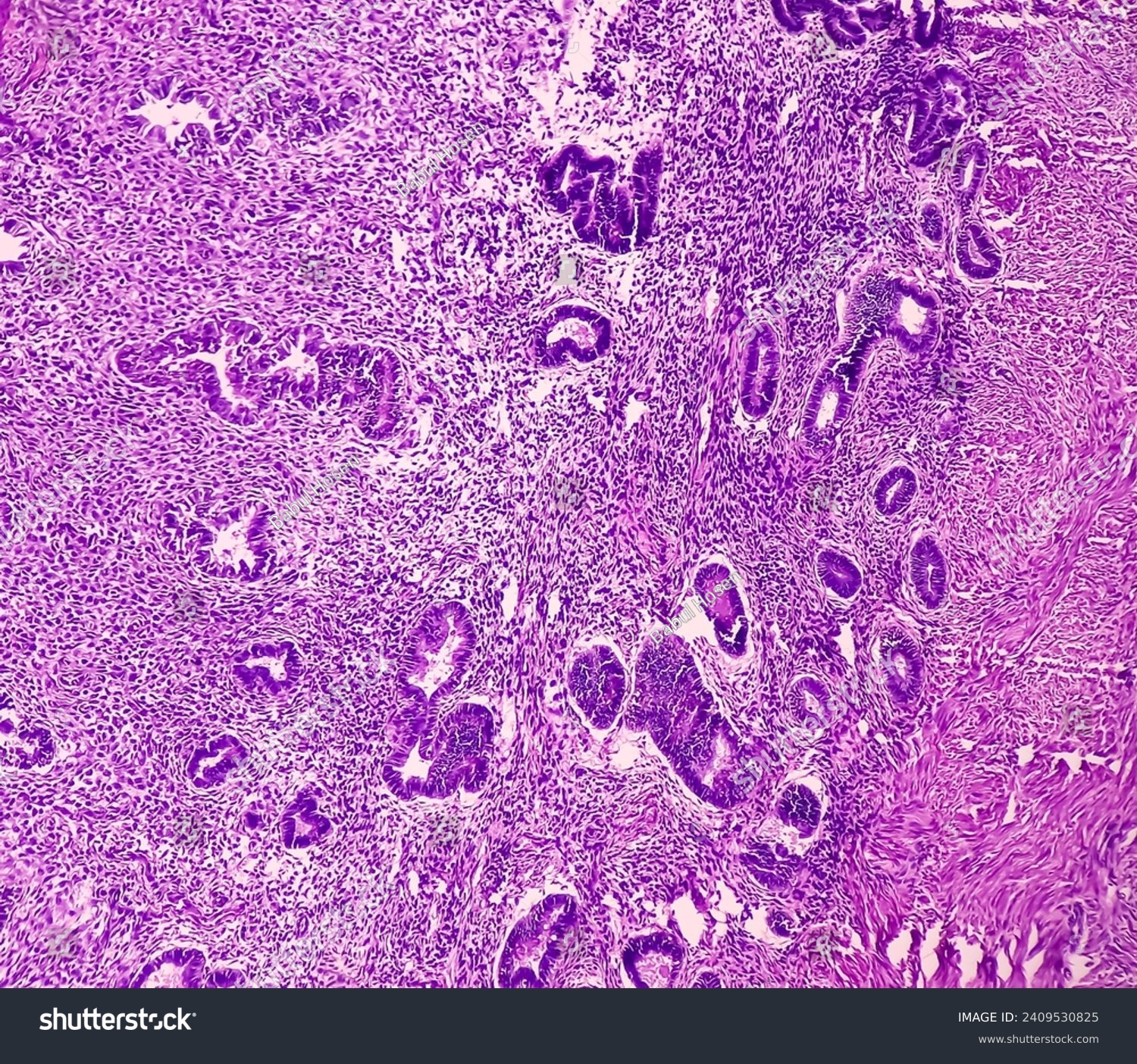 Uterus with adnexa (biopsy): Cervix show chronic inflamatory cells ...