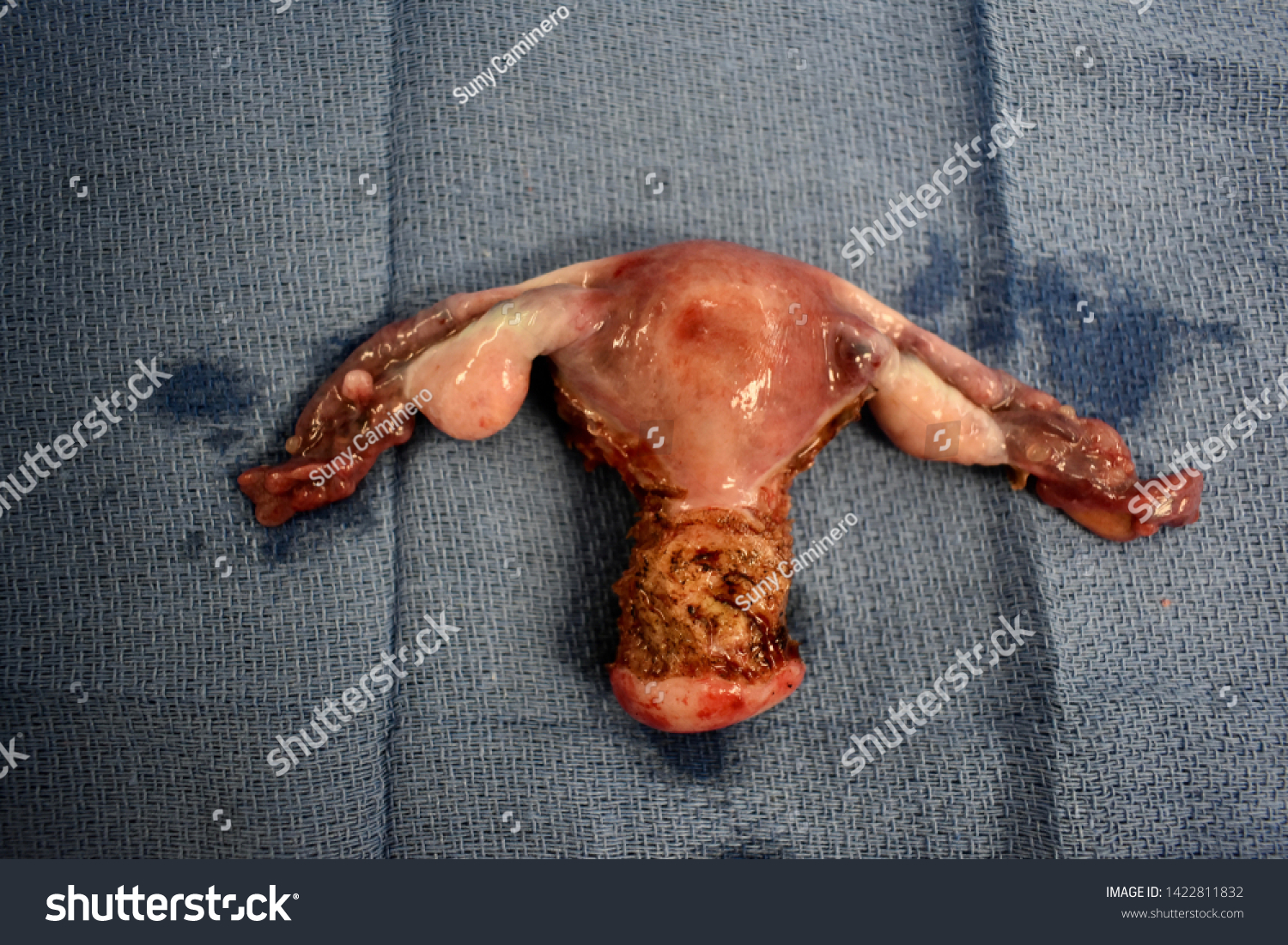 Uterus Cervix Fallopian Tubes Ovaries After Stock Photo Edit Now