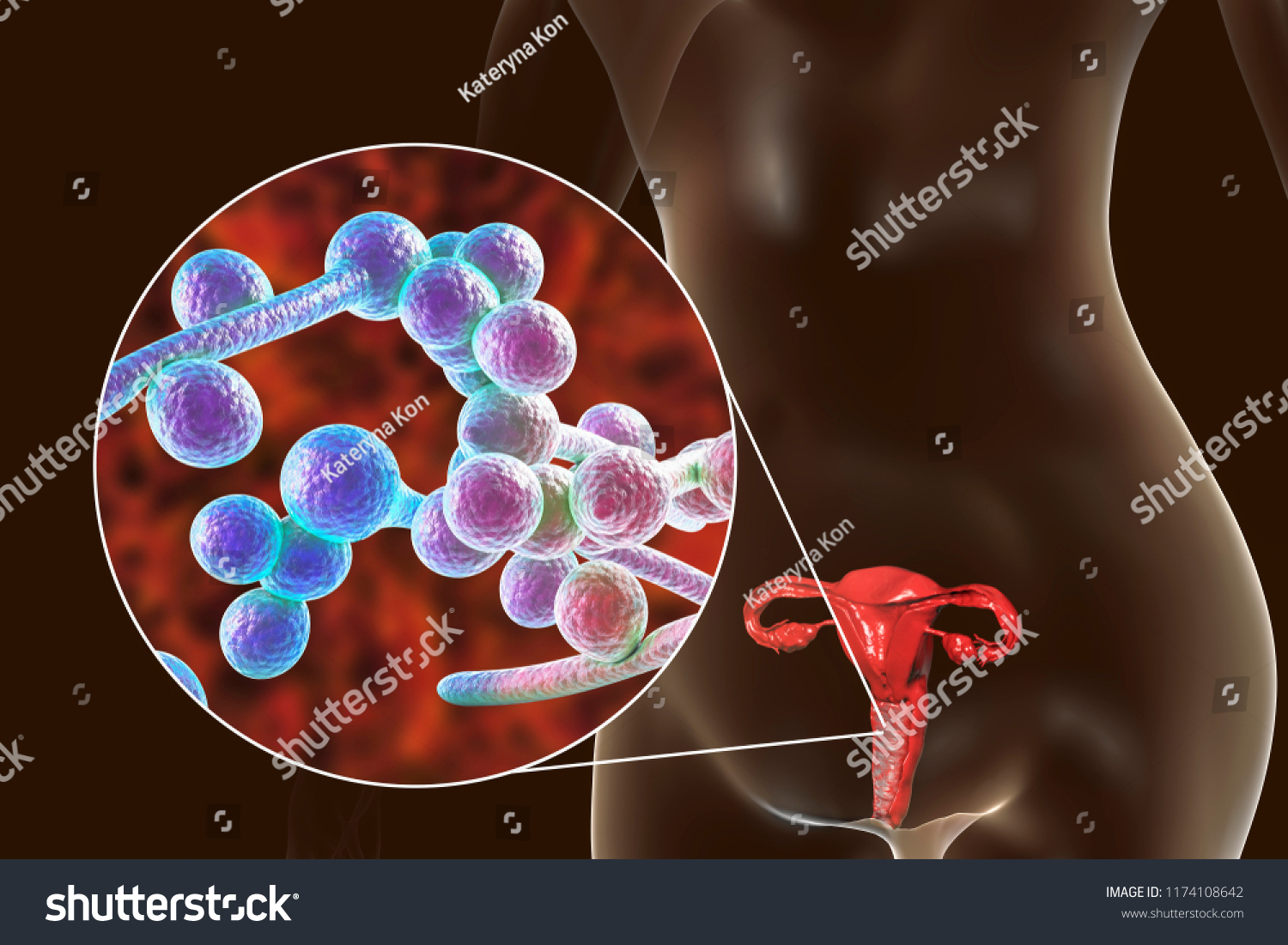 Vaginal Thrush Female Candidiasis 3d Illustration Stock Illustration 1174108642 