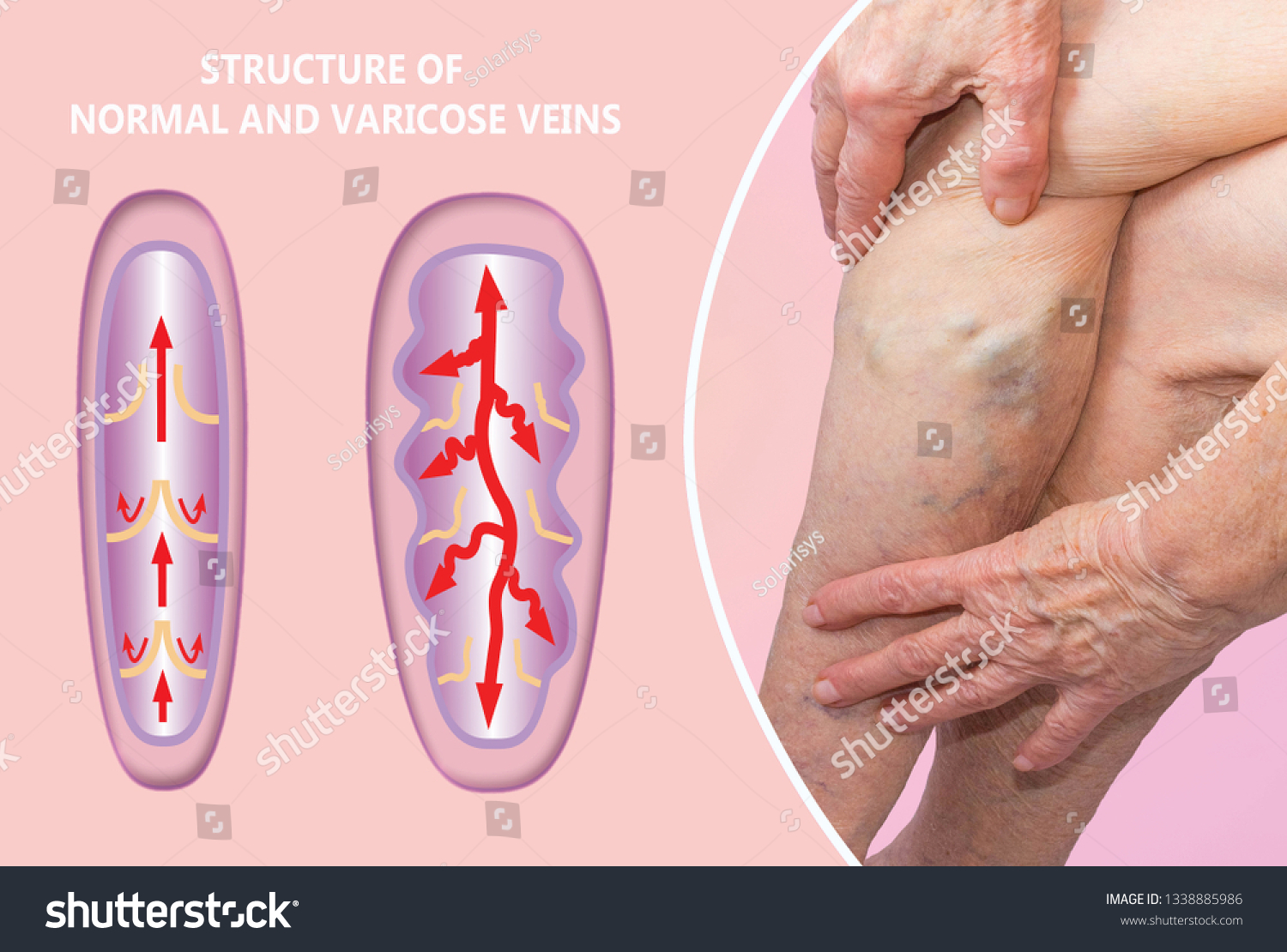 Varicose Veins On Female Senior Legs Stock Photo Edit Now