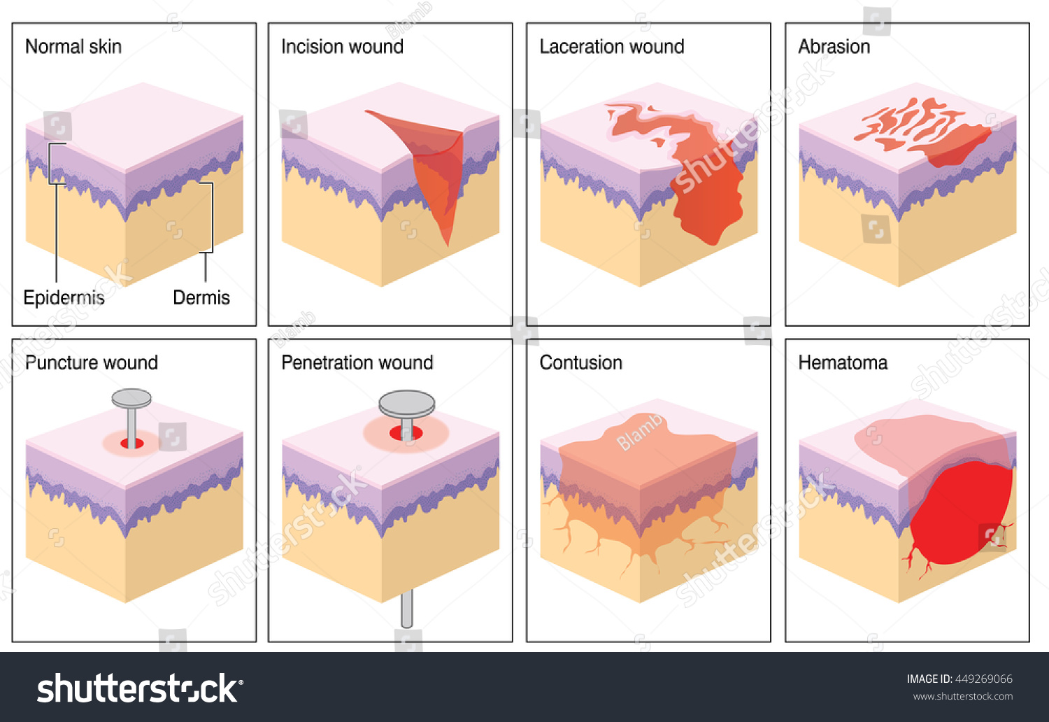 Types Of Wound Tissue