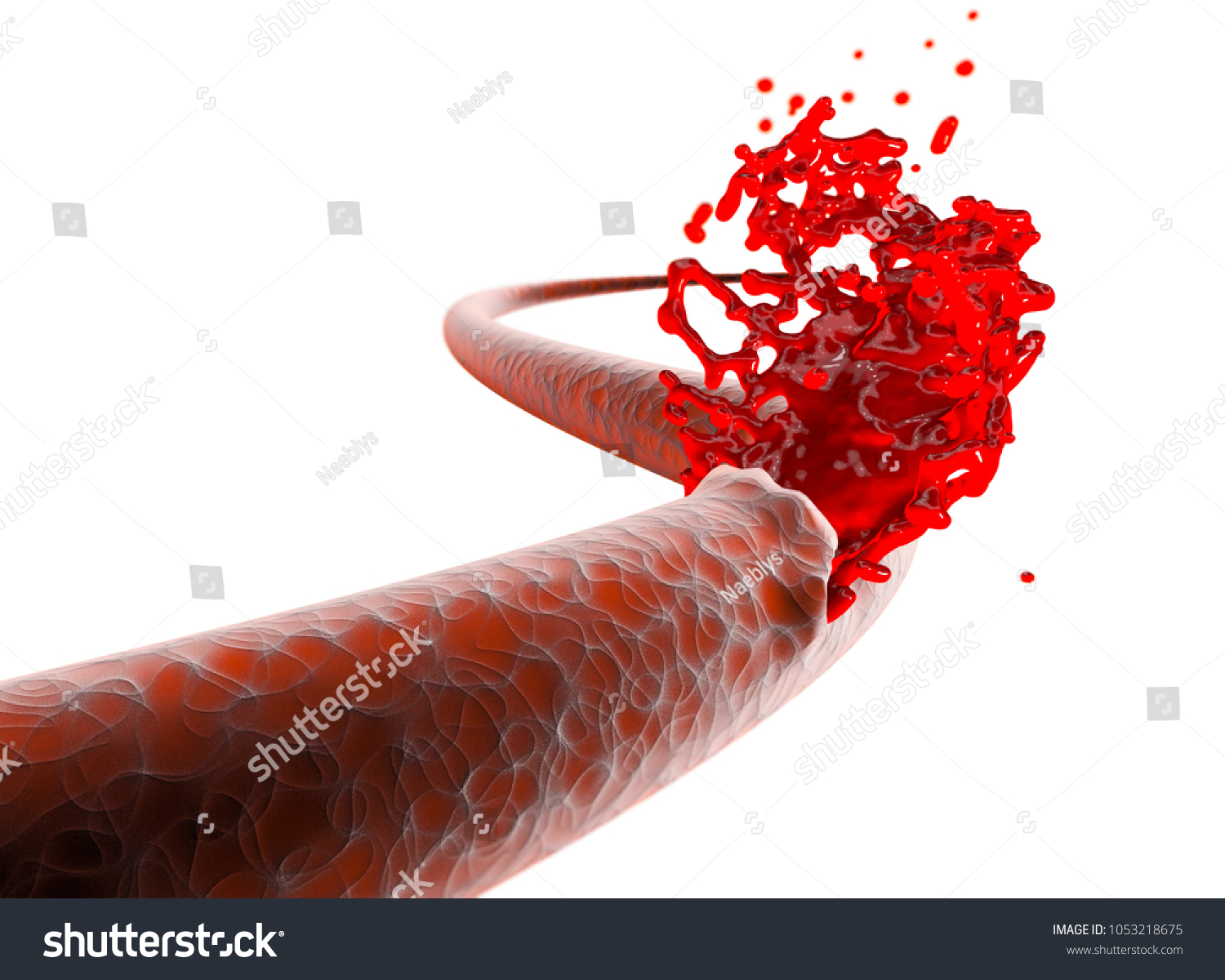 vein artery rupture cut blood hemorrhageのイラスト素材 1053218675