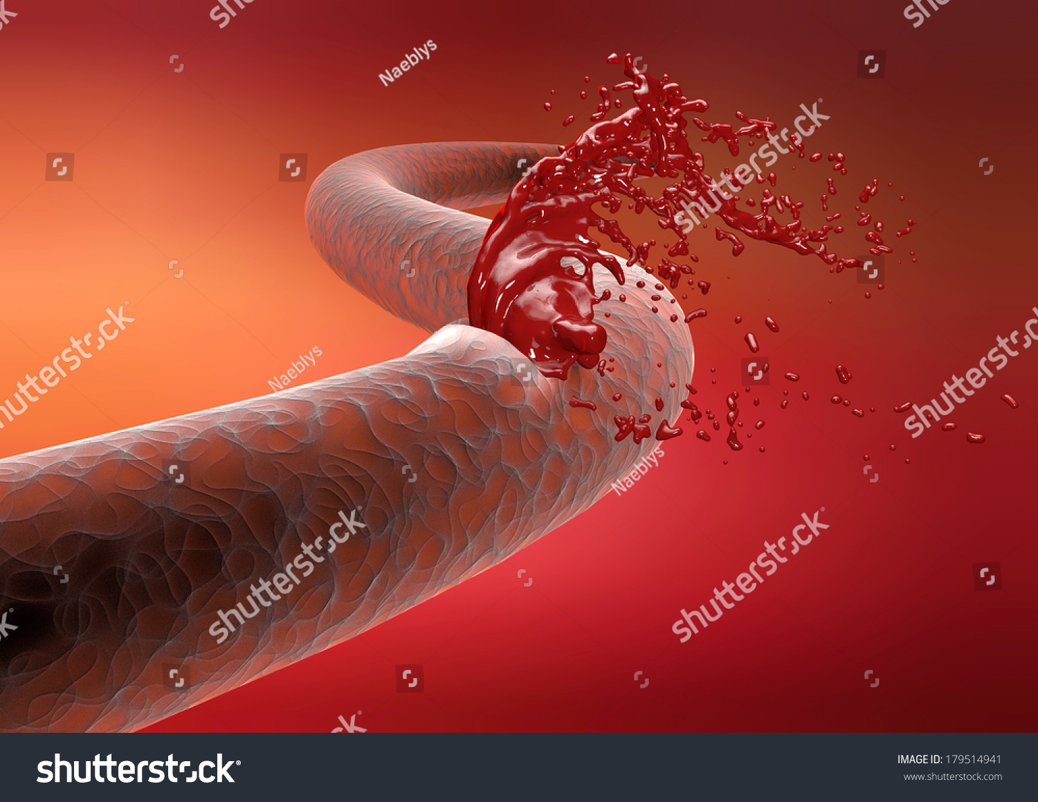 Vein Cut Artery Rupture Bleeding Blood Stock Illustration 179514941