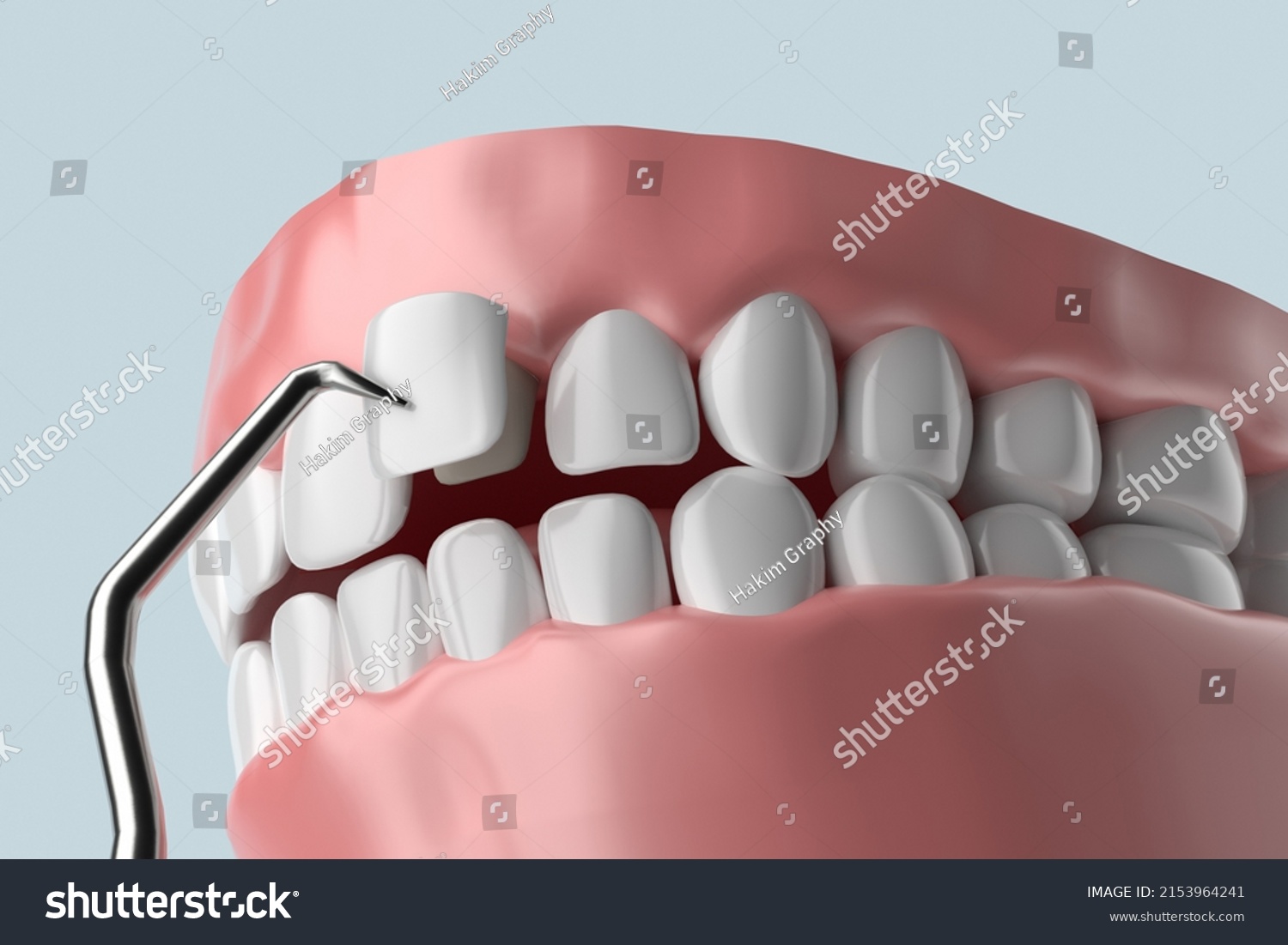 Veneer Installation Procedure Over Central Incisor Stock Illustration ...