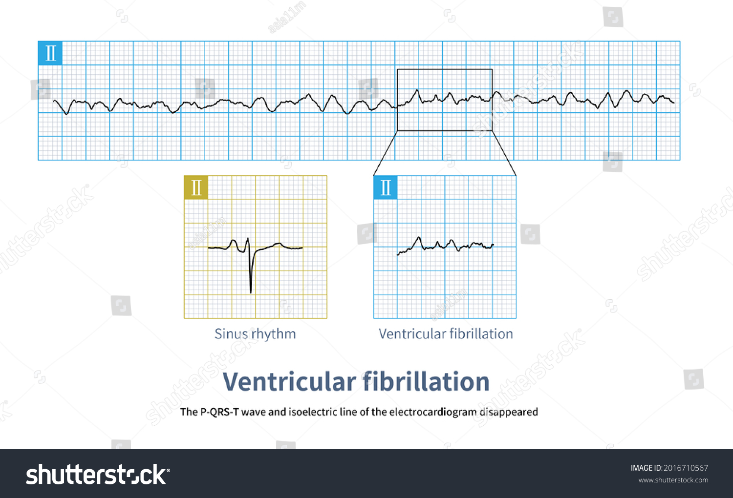 Ventricular Fibrillation One Forms Cardiac Arrest Stock Illustration ...