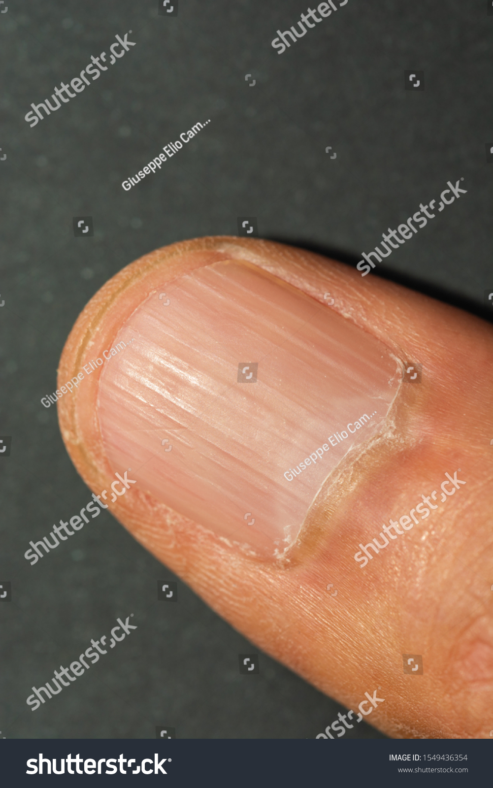 Vertical Ridges On Fingernails Symptoms Deficiency Stock Photo